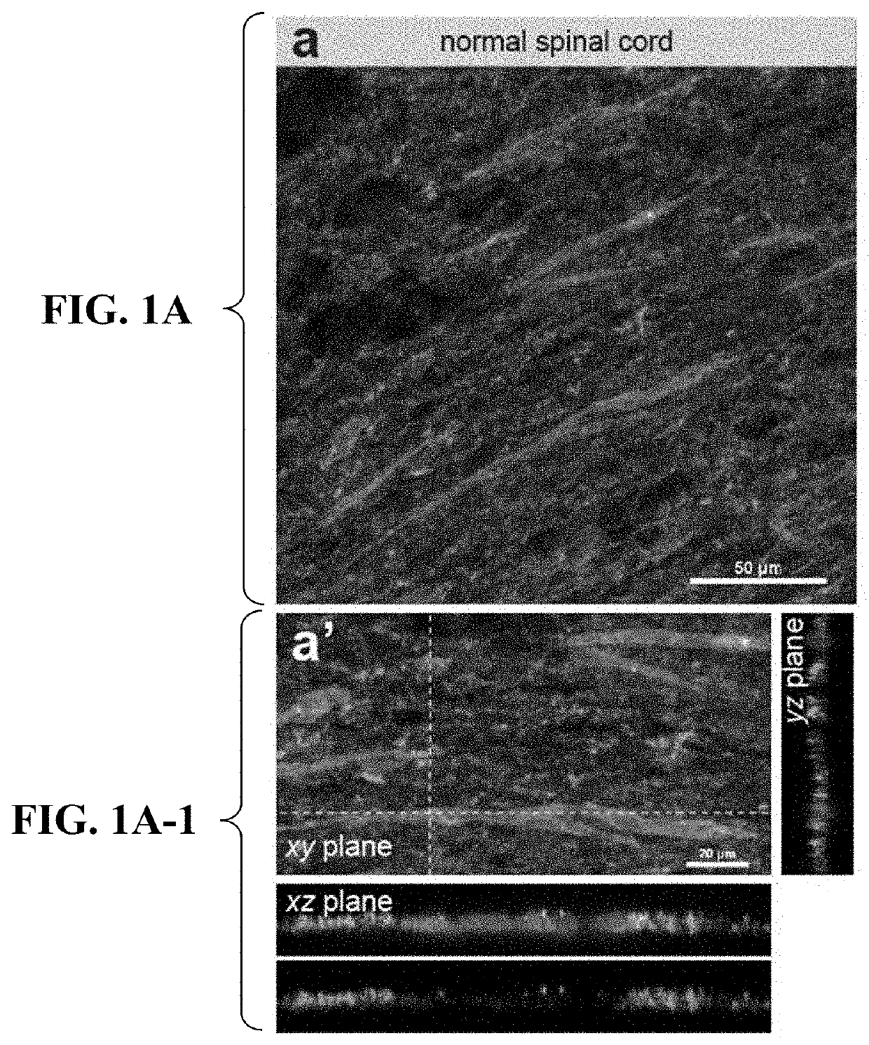 Inhibition of vascular endothelial cell-mediated phagocytic processes for treatment of demyelinating conditions