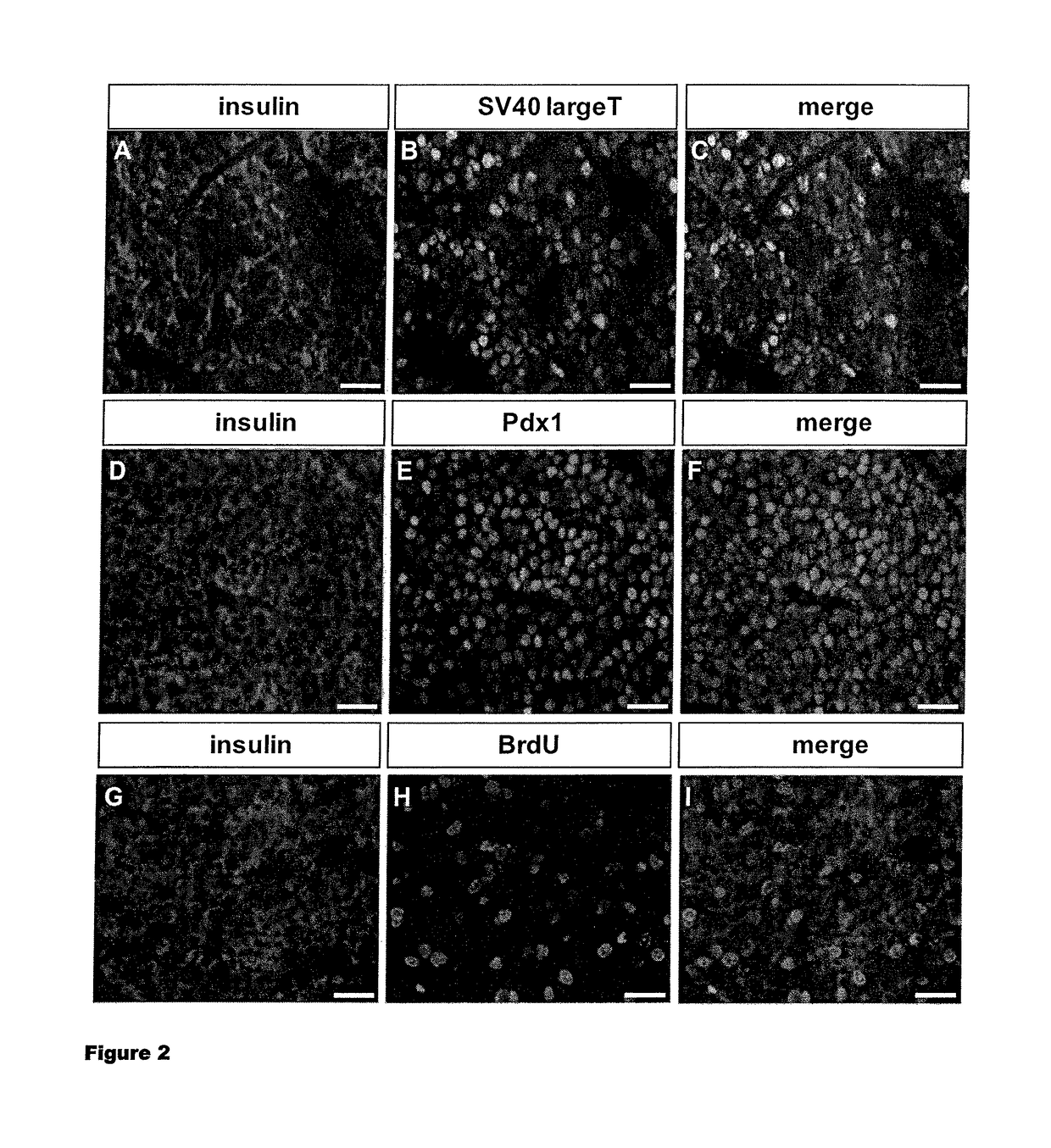 Human pancreatic beta cell lines for diagnostic of diabetes