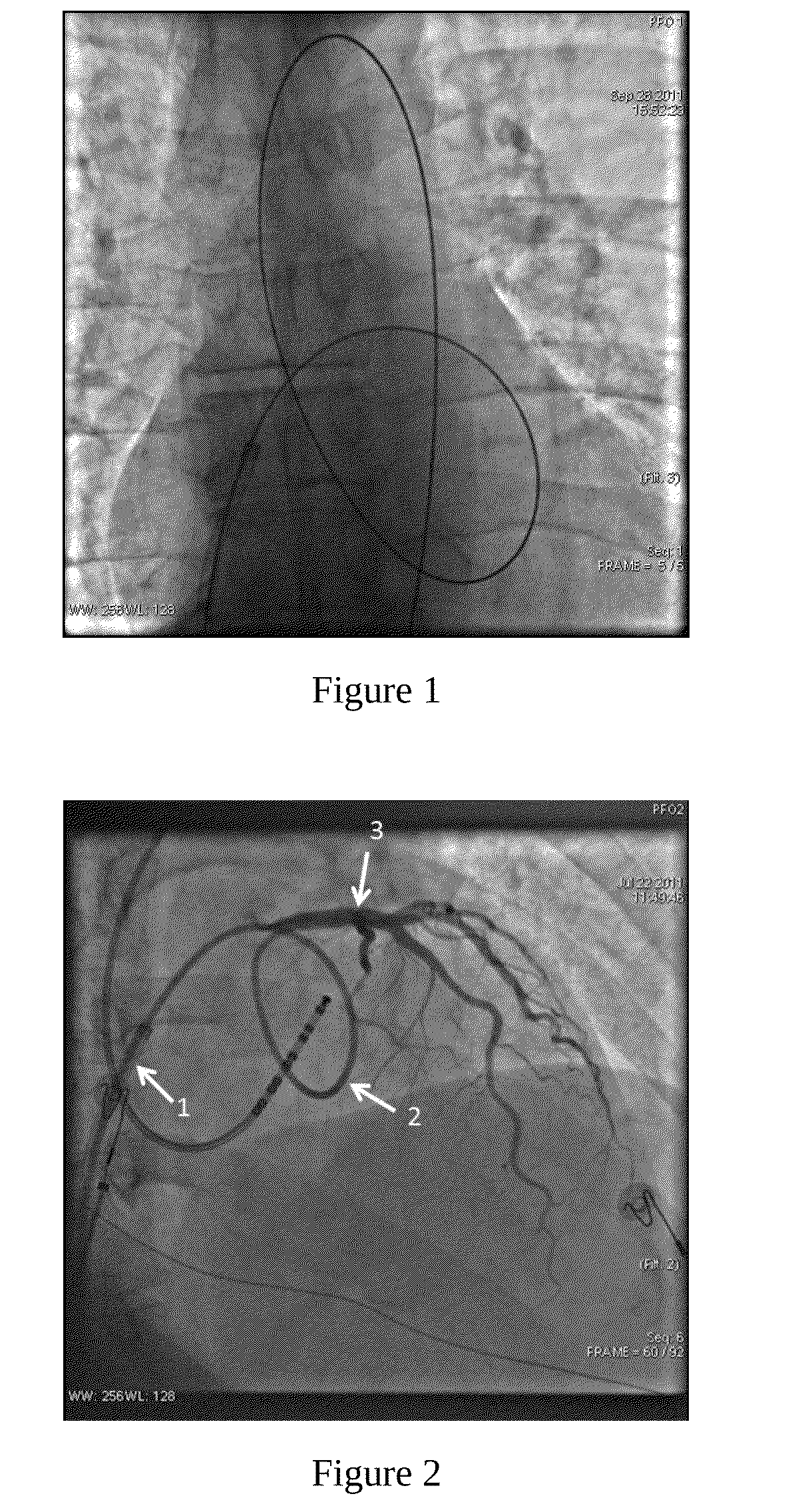 Method for the catheterization of the coronary arteries and catheter for the implementation thereof