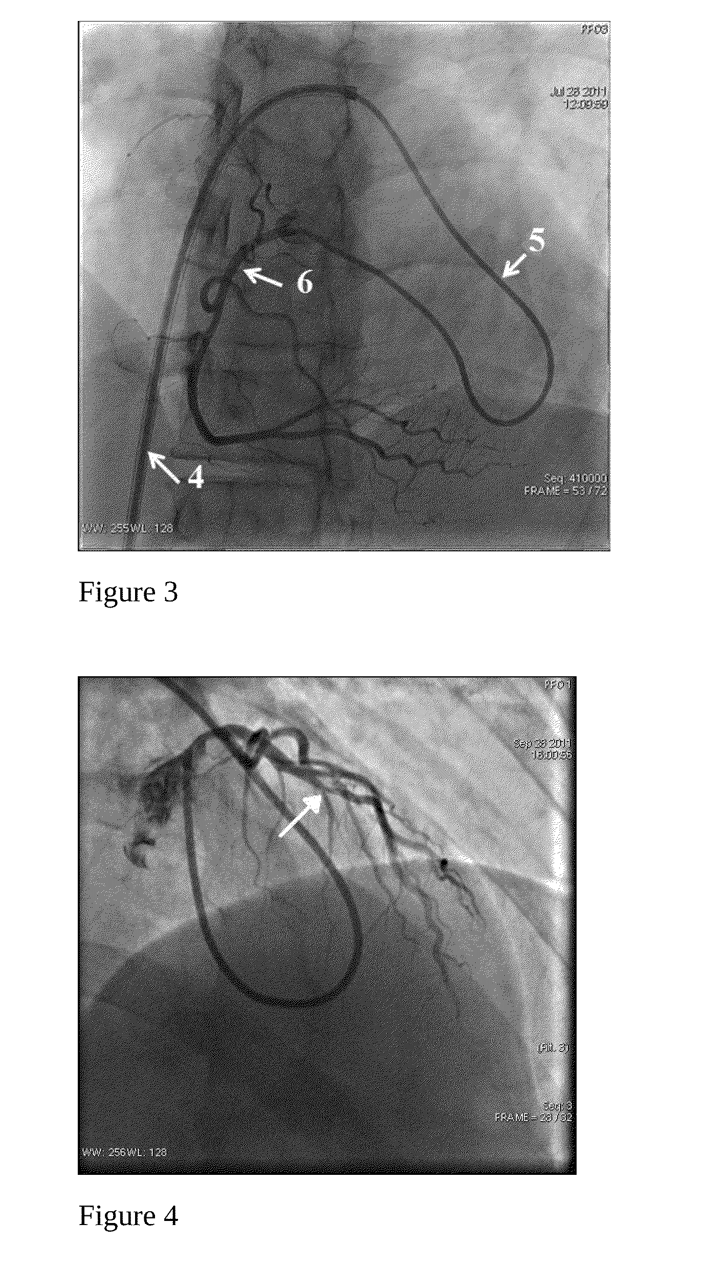 Method for the catheterization of the coronary arteries and catheter for the implementation thereof