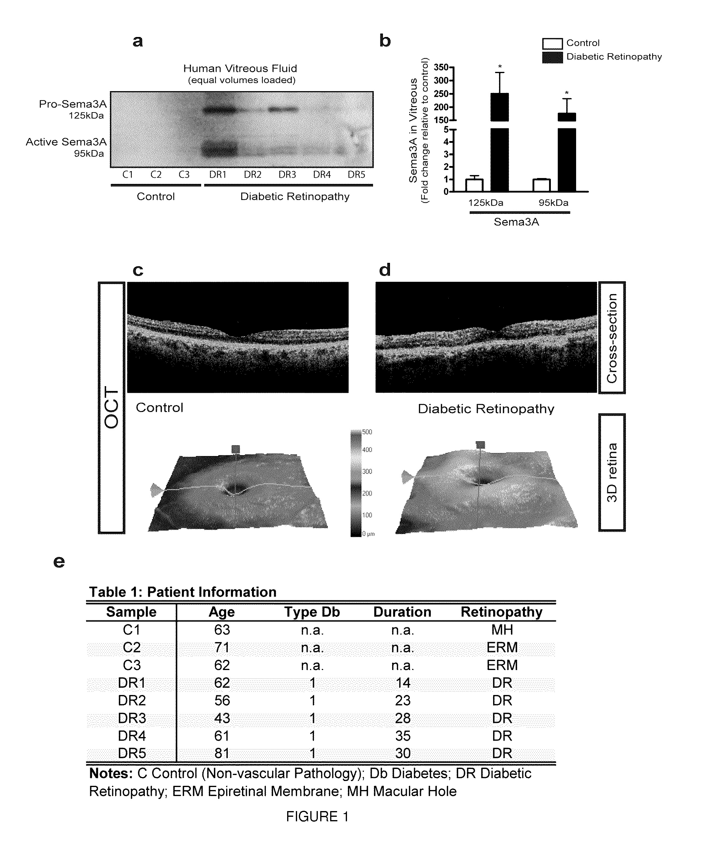 Inhibition of sema3a in the prevention and treatment of ocular hyperpermeability