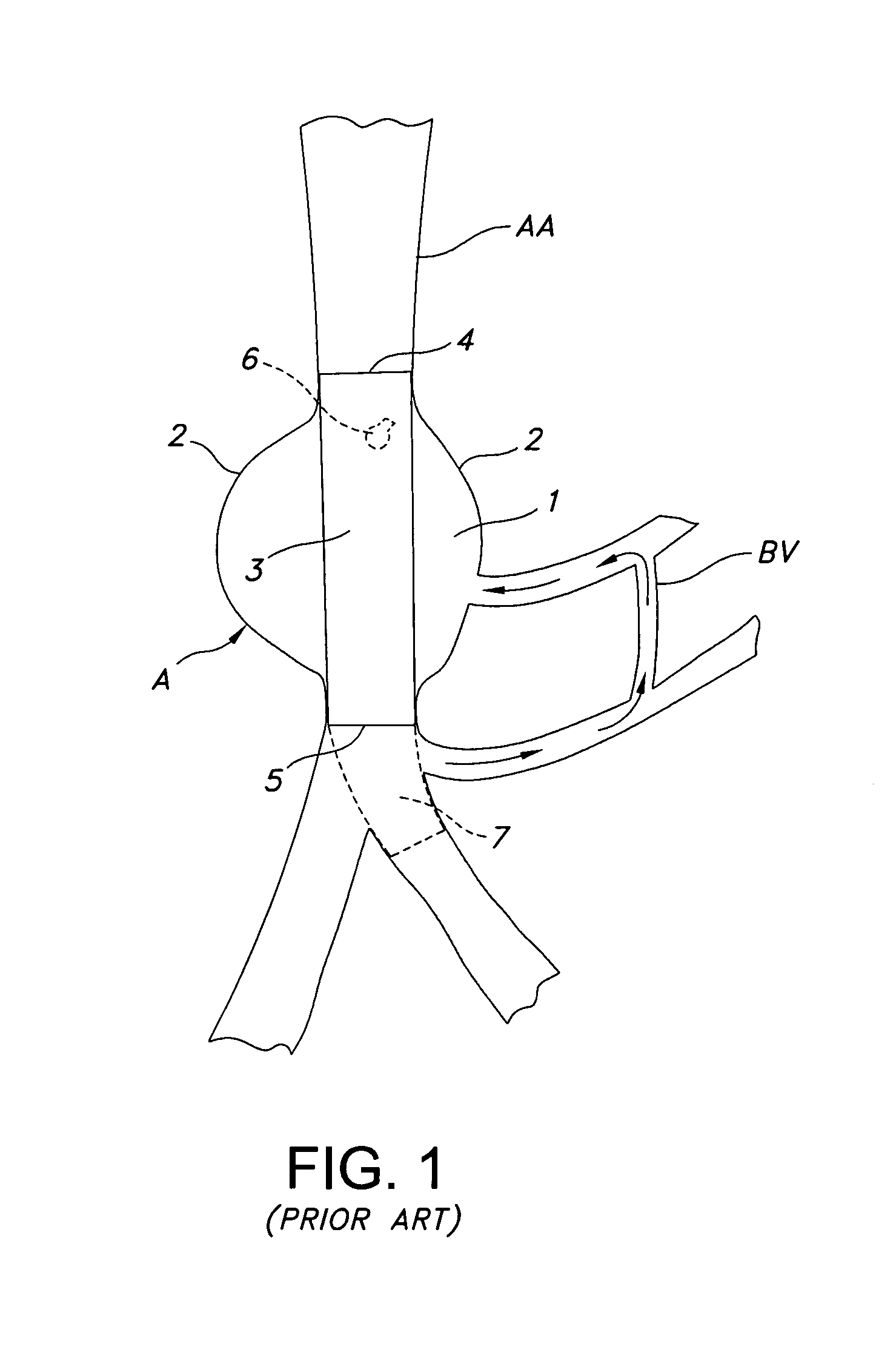 Aortic artery aneurysm endovascular prosthesis