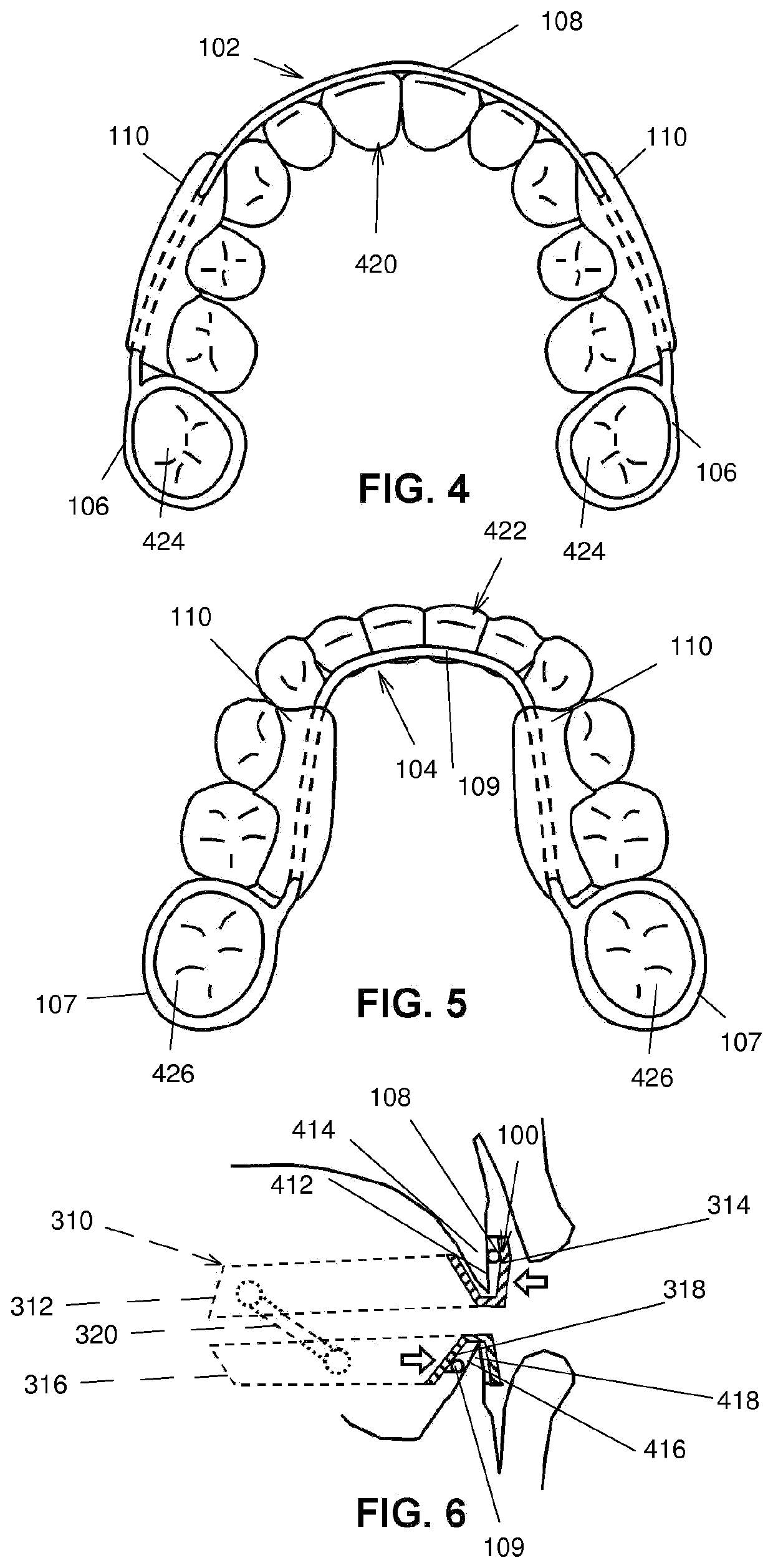 Intraoral device and method of using same