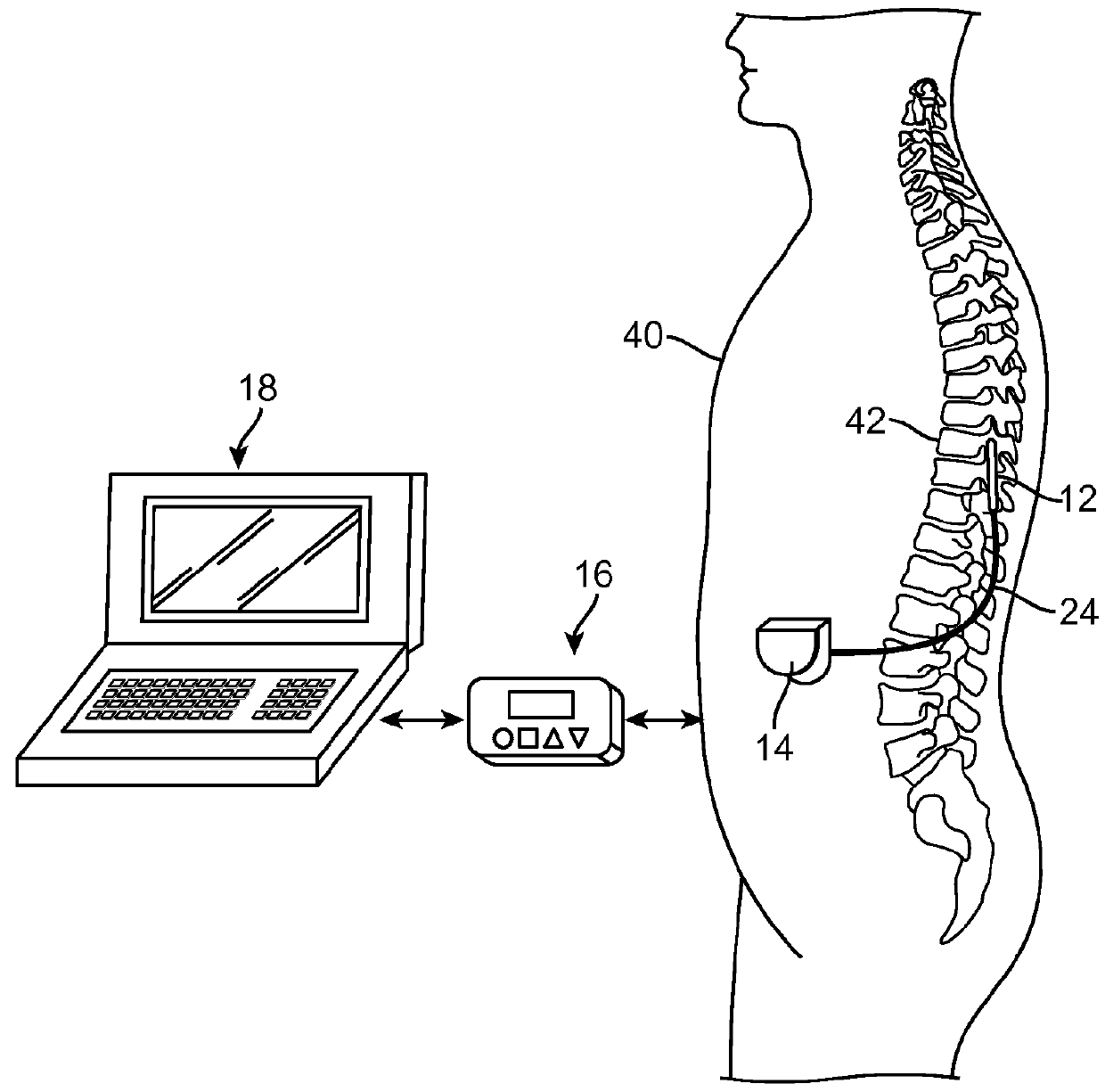 Neurostimulation system having increased flexibility for creating complex pulse trains