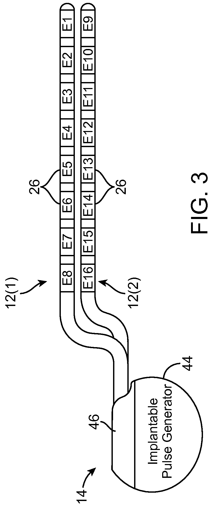 Neurostimulation system having increased flexibility for creating complex pulse trains