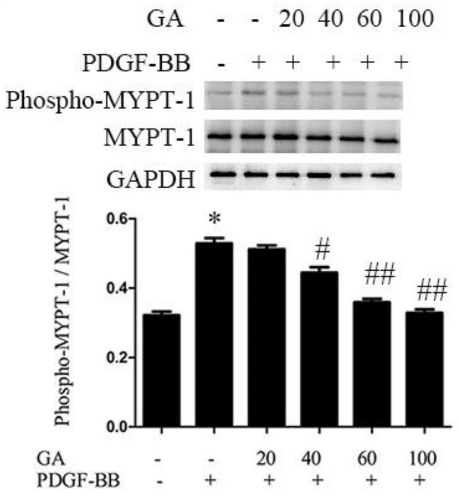 Application of ginkgolic acid in preparation and treatment of drug for treating vascular restenosis diseases