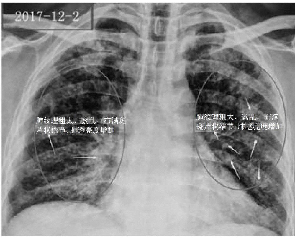 A traditional Chinese medicine compound composition for treating pneumoconiosis and pulmonary fibrosis and its preparation method