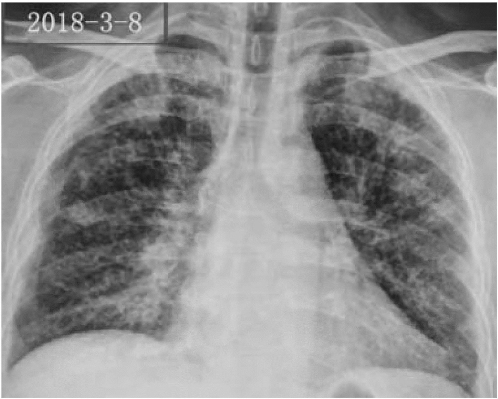 A traditional Chinese medicine compound composition for treating pneumoconiosis and pulmonary fibrosis and its preparation method