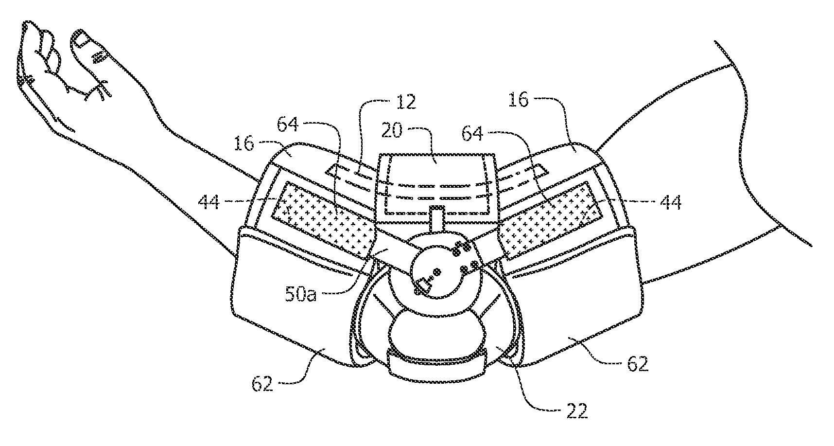 Laterally applied orthosis