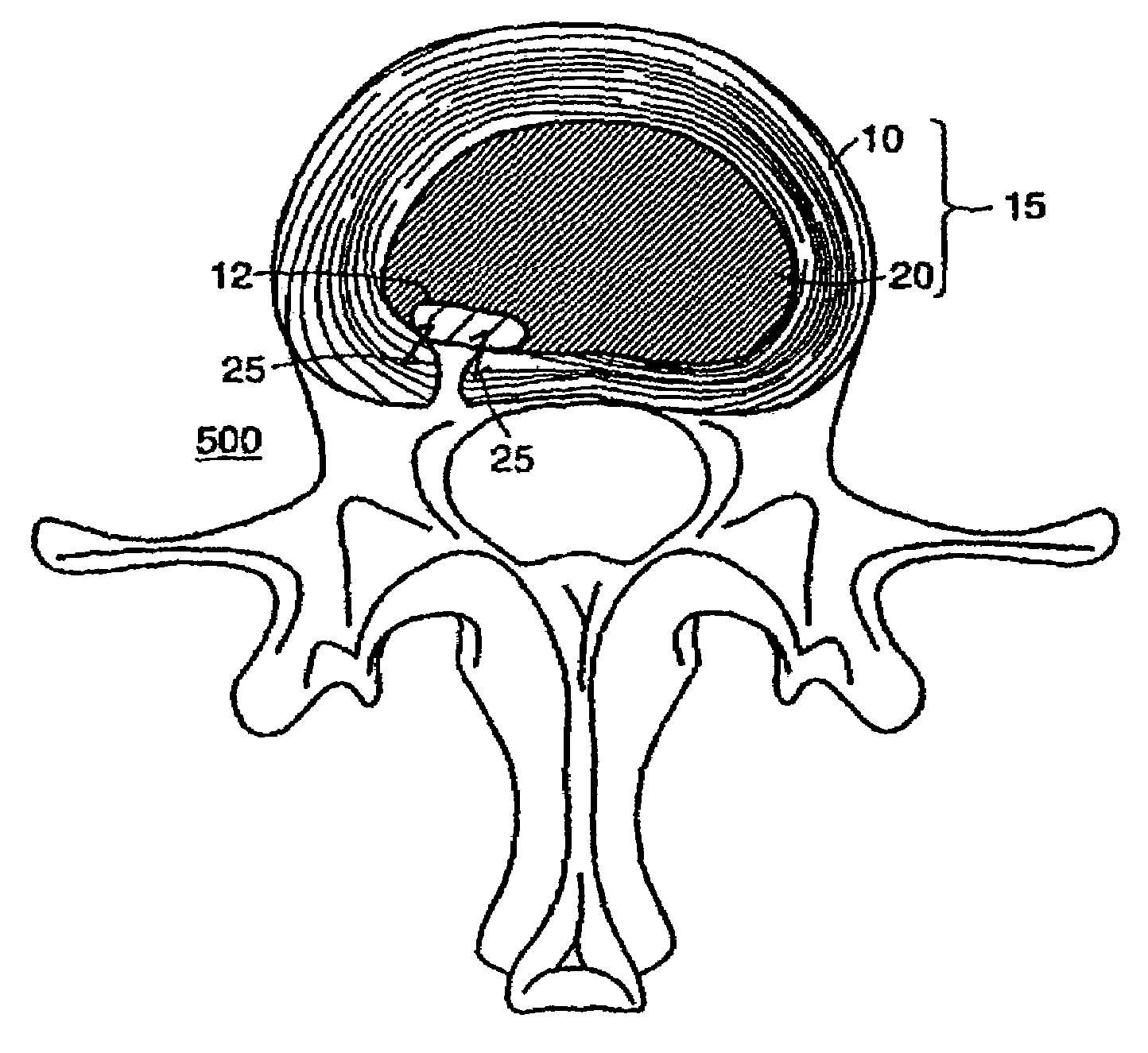 Anchored anulus method