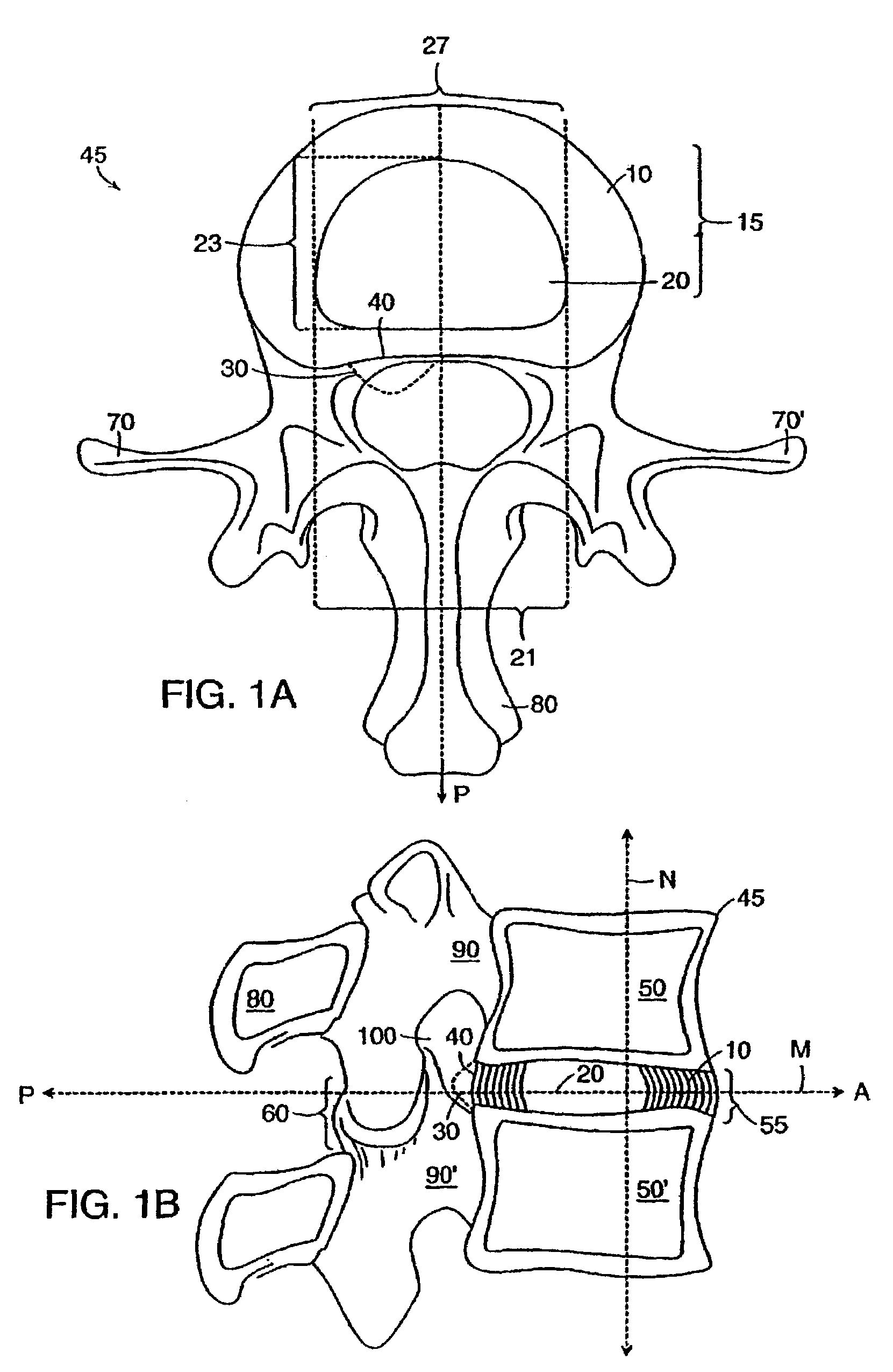 Anchored anulus method