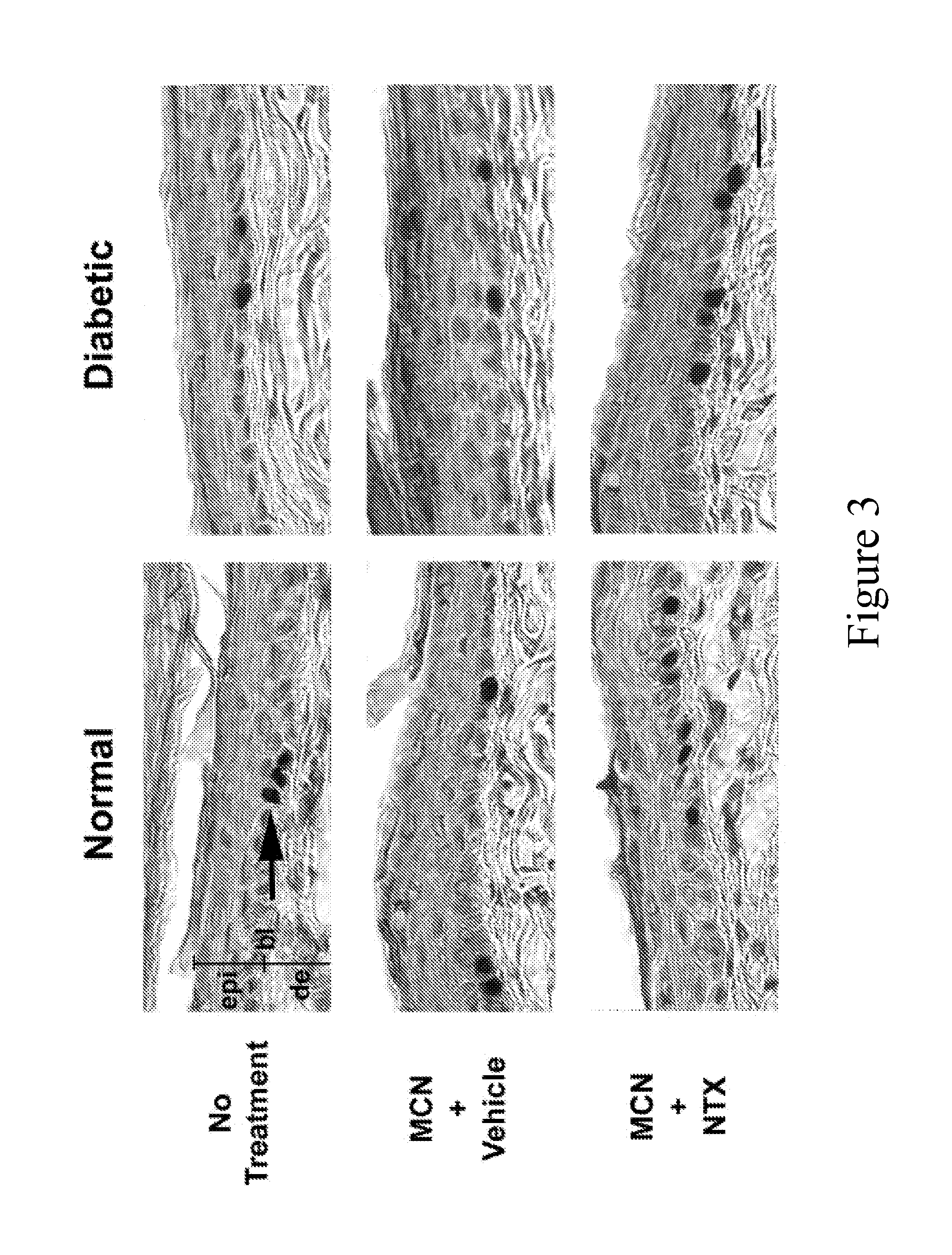 Methods and compositions for treatment of epithelial wounds