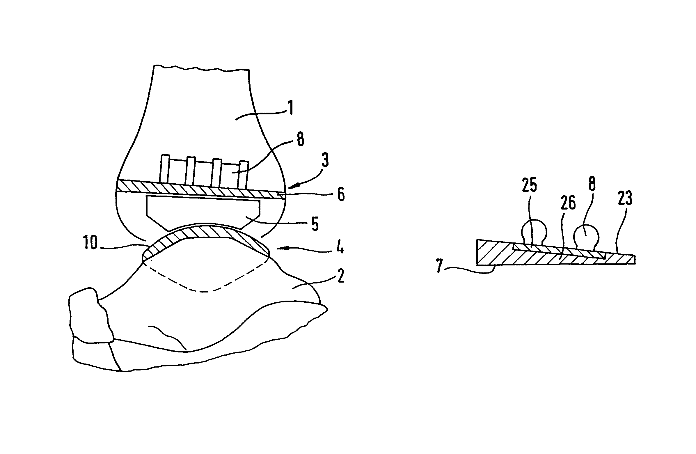 Ankle-joint endoprosthesis