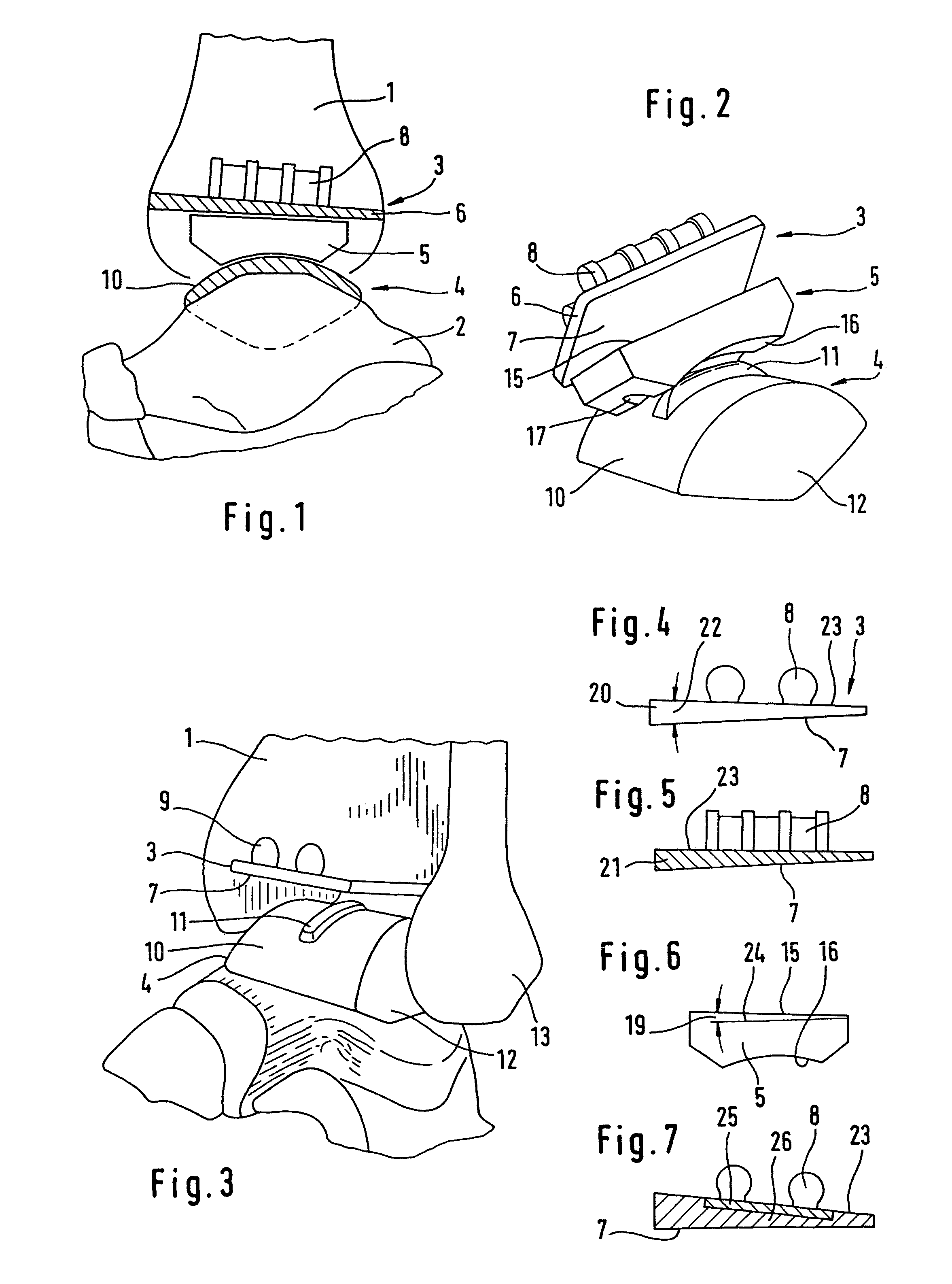 Ankle-joint endoprosthesis