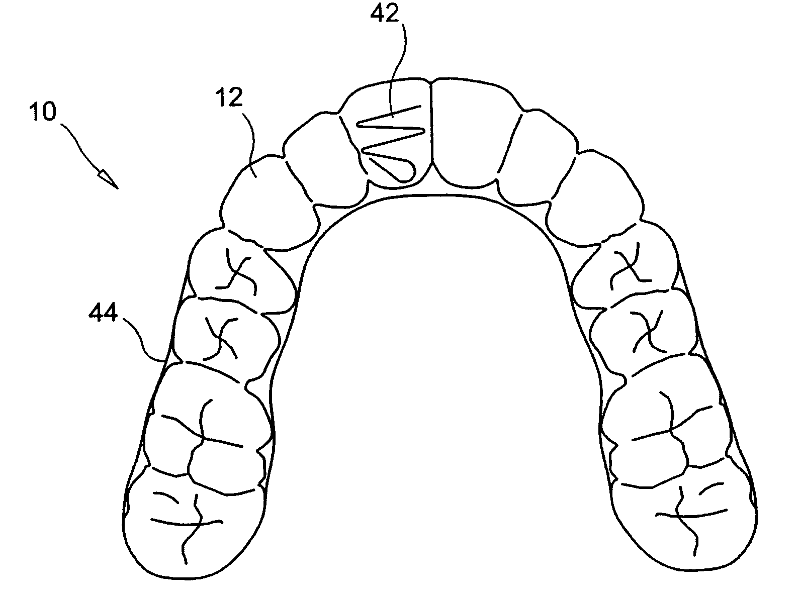 Orthodontic appliance with embedded wire for moving teeth and method