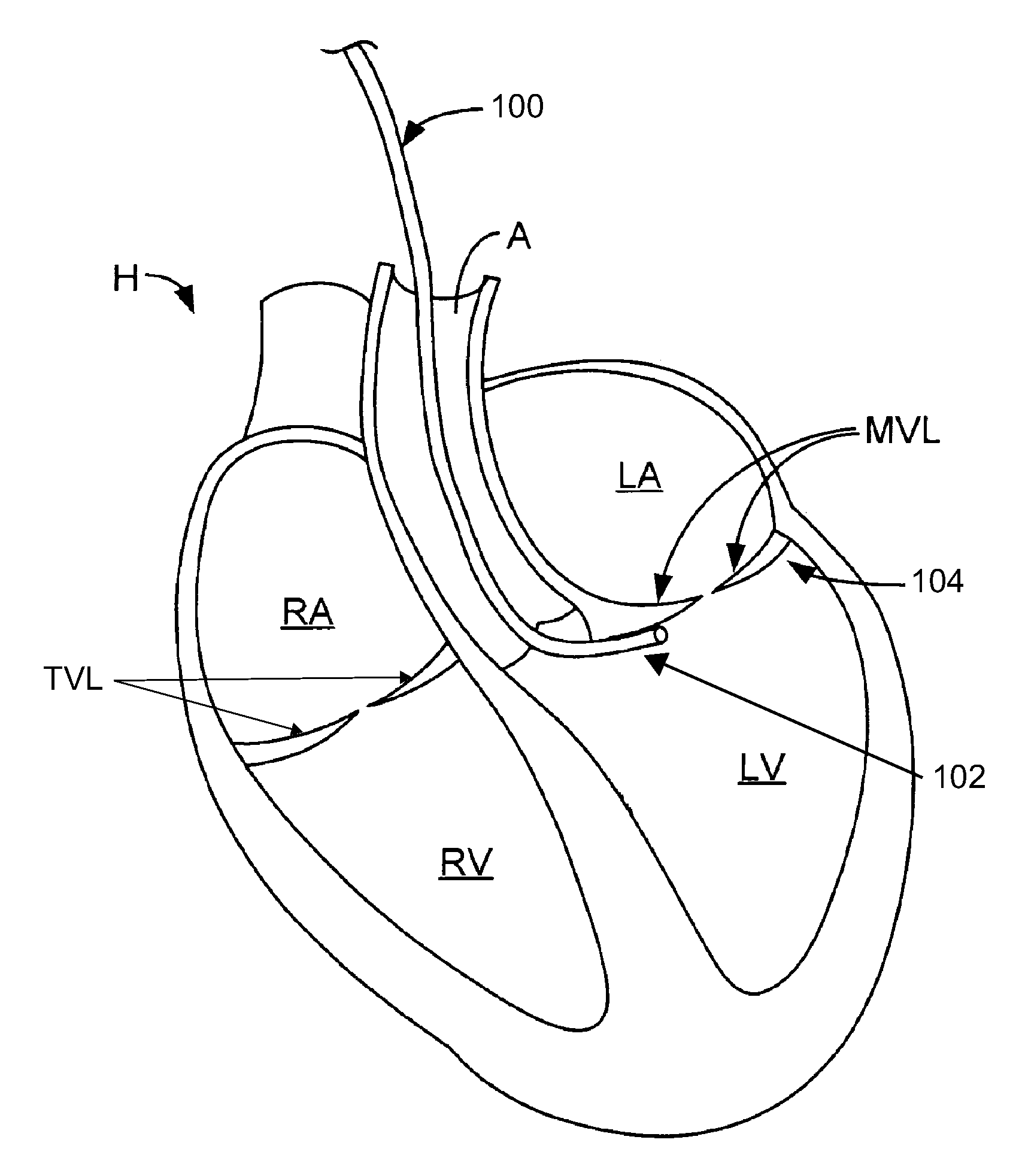 Systems and methods for cardiac remodeling