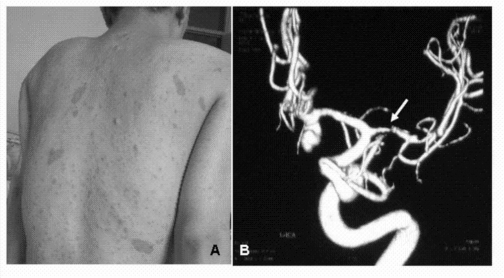 I type neurofibroma NF1 gene mutation nucleotide sequence related to cerebrovascular stenosis and application thereof