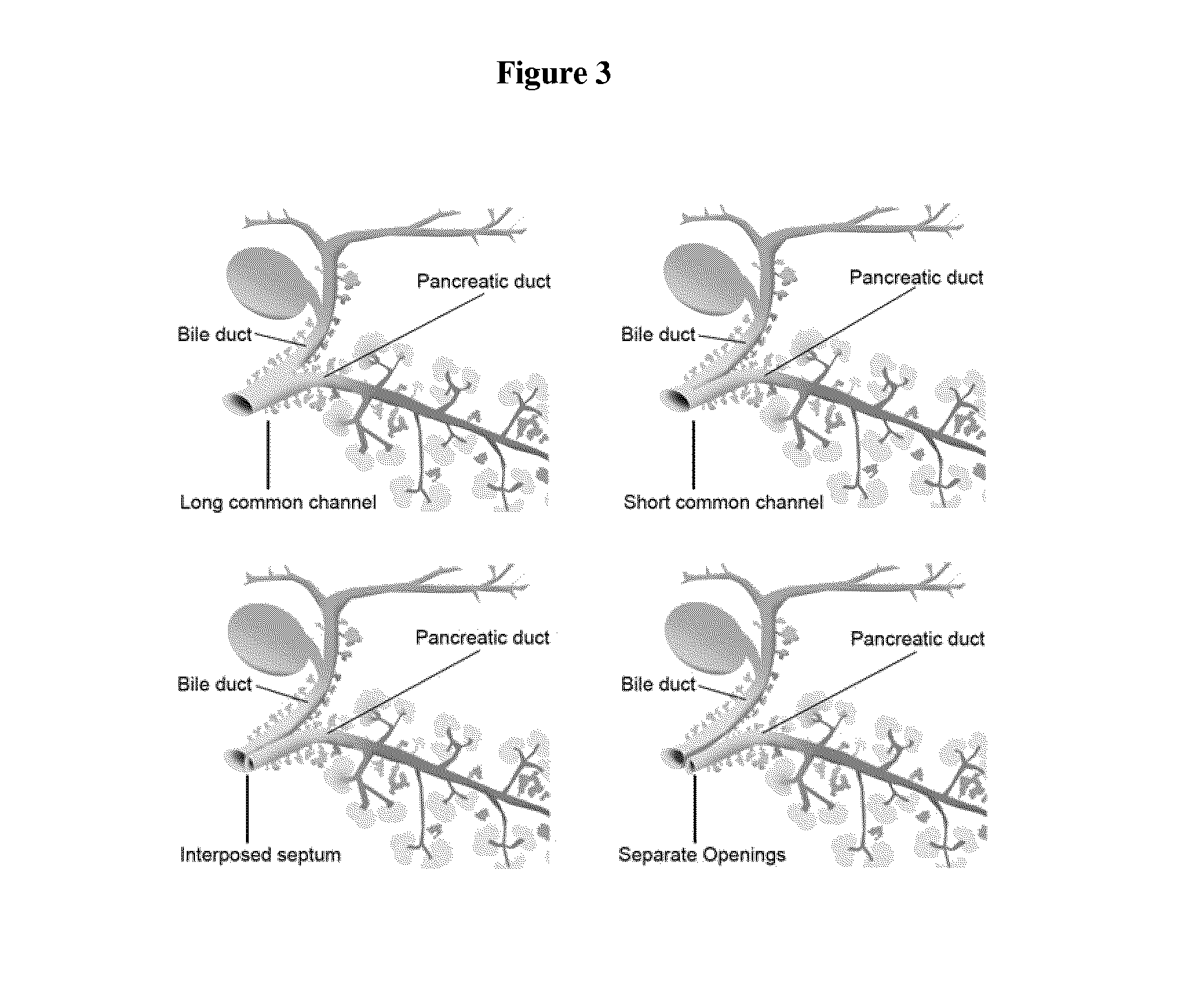 Method of treating pancreatic and liver conditions by endoscopic-mediated (or laparoscopic-mediated) transplantation of stem cells into/onto bile duct walls of particular regions of the biliary tree