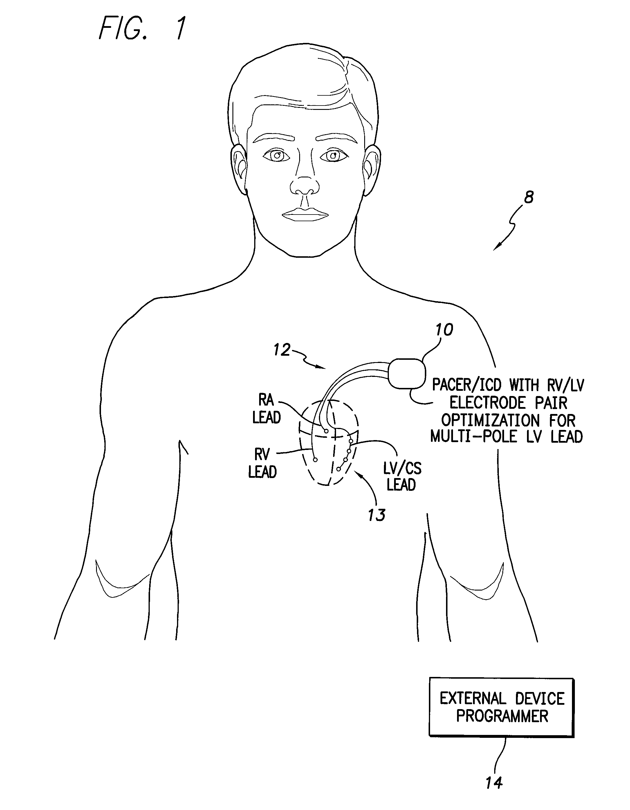 Systems and methods for determining optimal electrode pairs for use in biventricular pacing using multi-pole ventricular leads