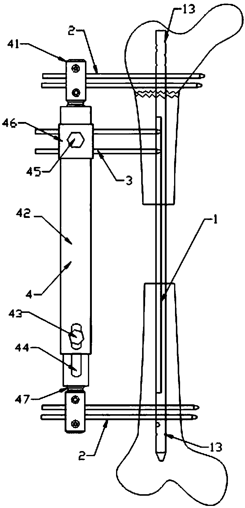 A bone-handling device for large segmental bone defect of femur