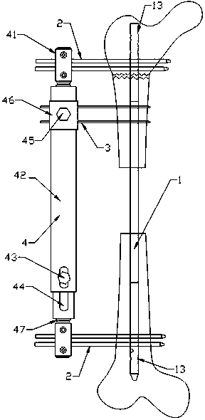 A bone-handling device for large segmental bone defect of femur