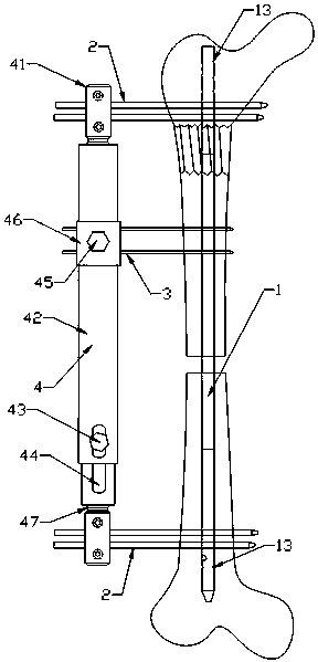 A bone-handling device for large segmental bone defect of femur