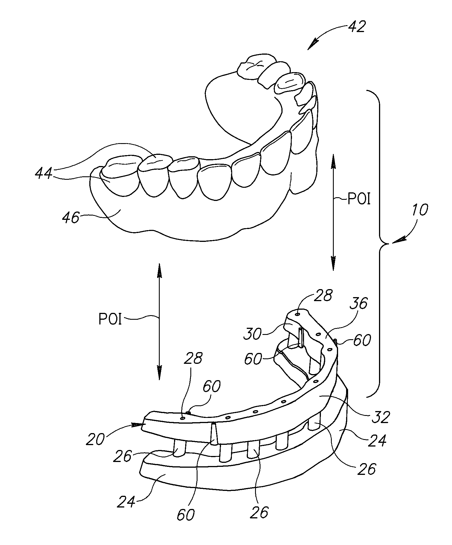 Denture stabilization system and method