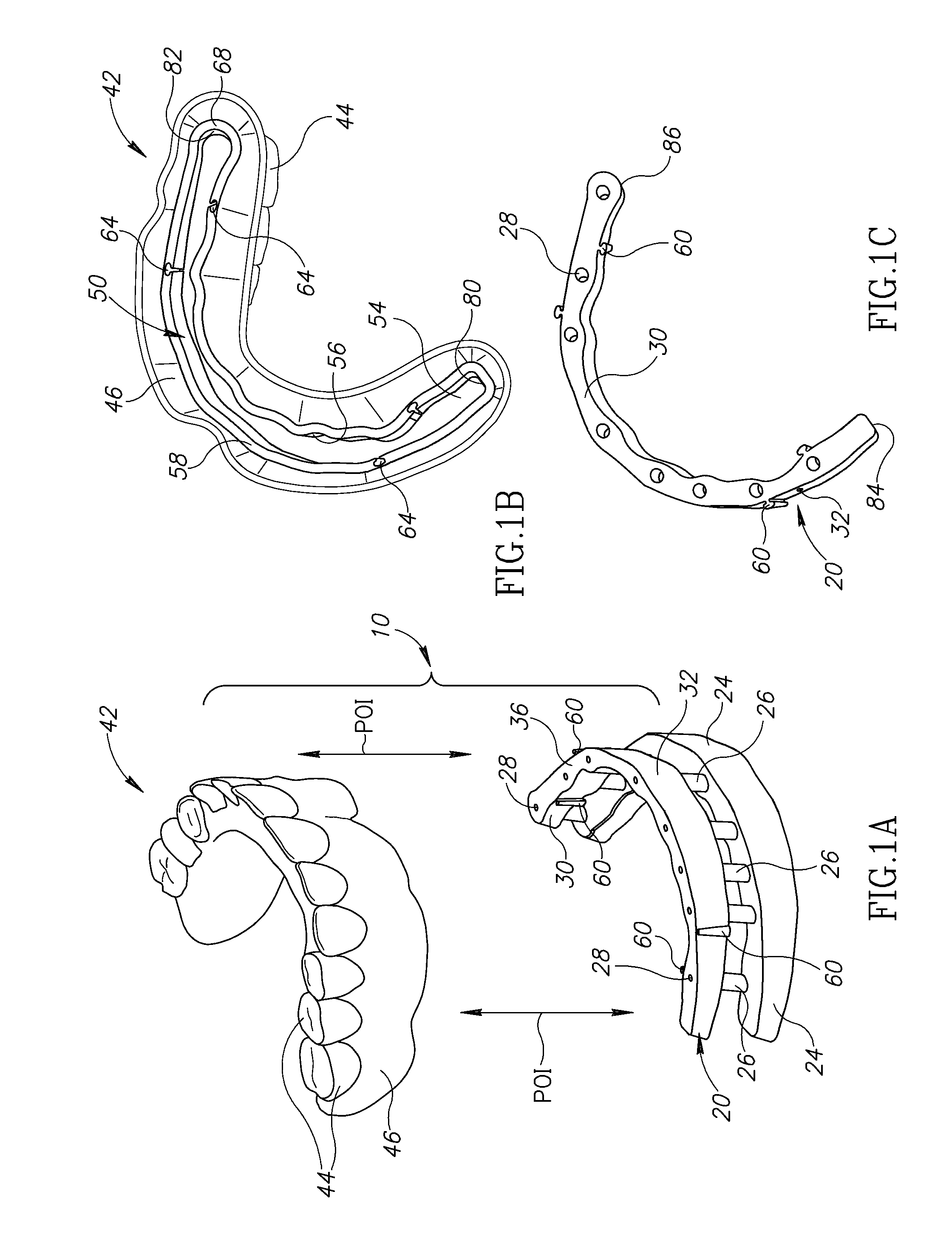 Denture stabilization system and method