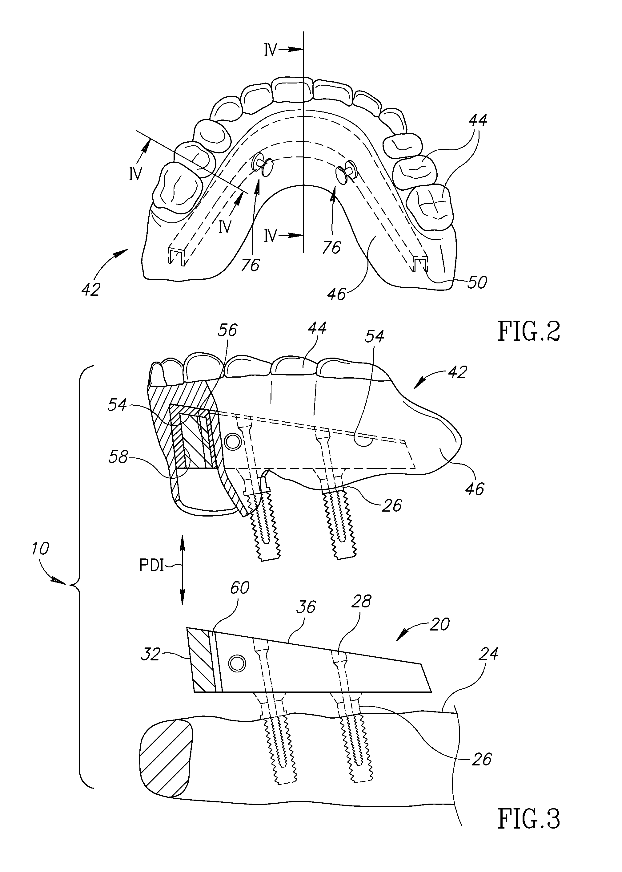 Denture stabilization system and method