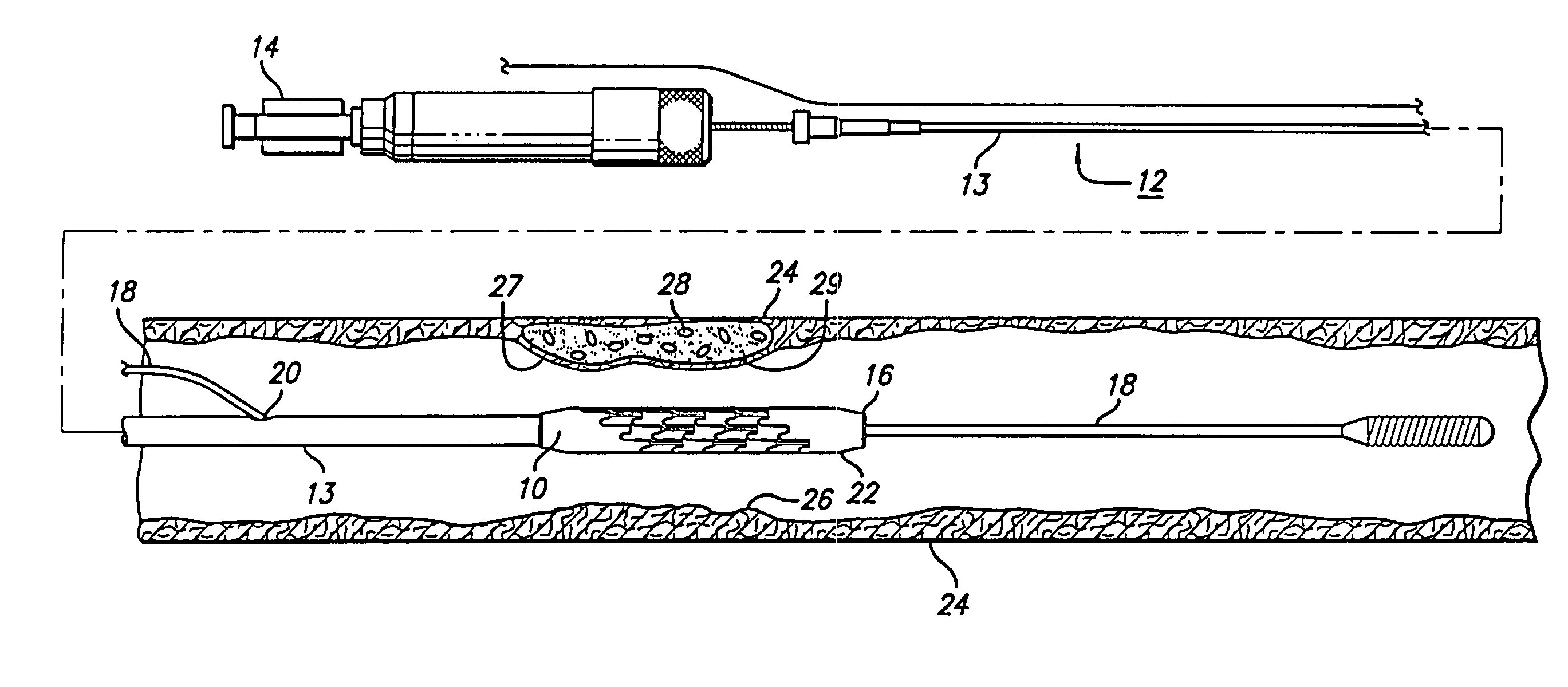 Inclined stent pattern for vulnerable plaque