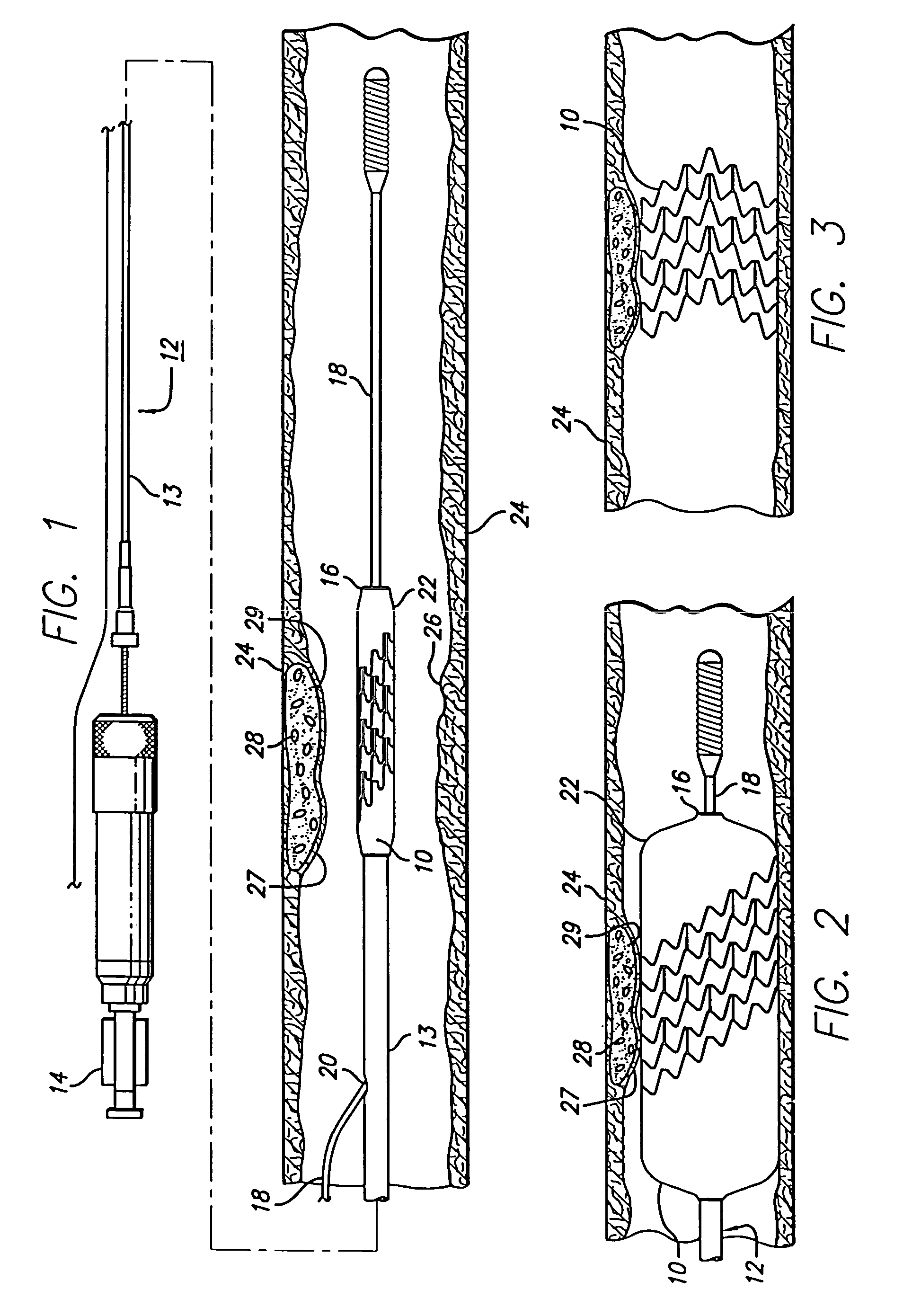 Inclined stent pattern for vulnerable plaque