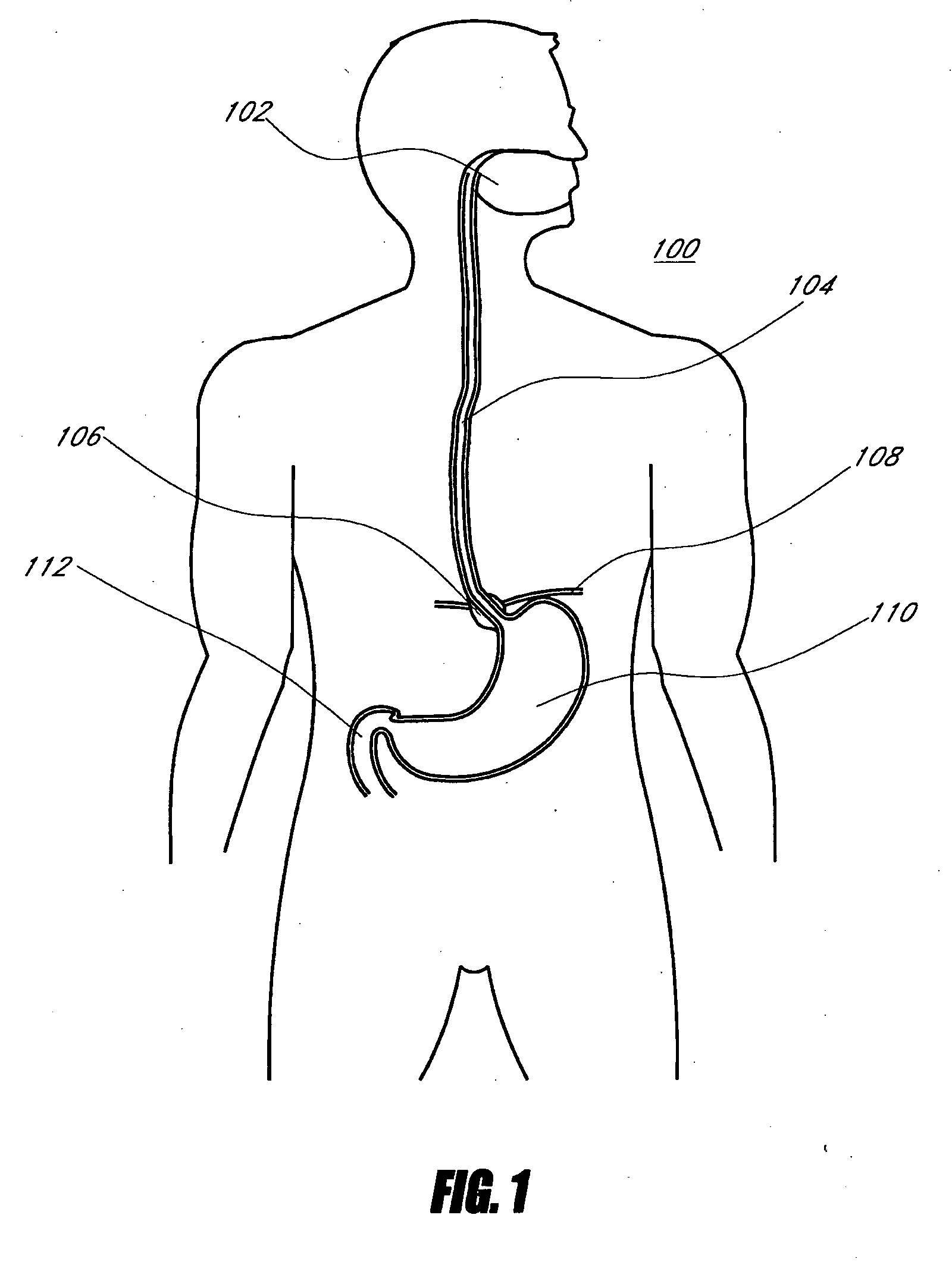 Method and apparatus for adjusting body lumens