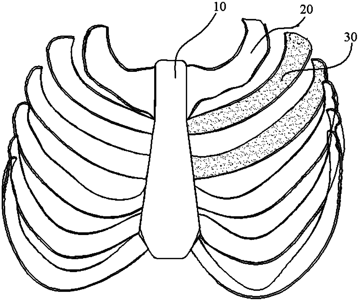 Sternal prosthesis device