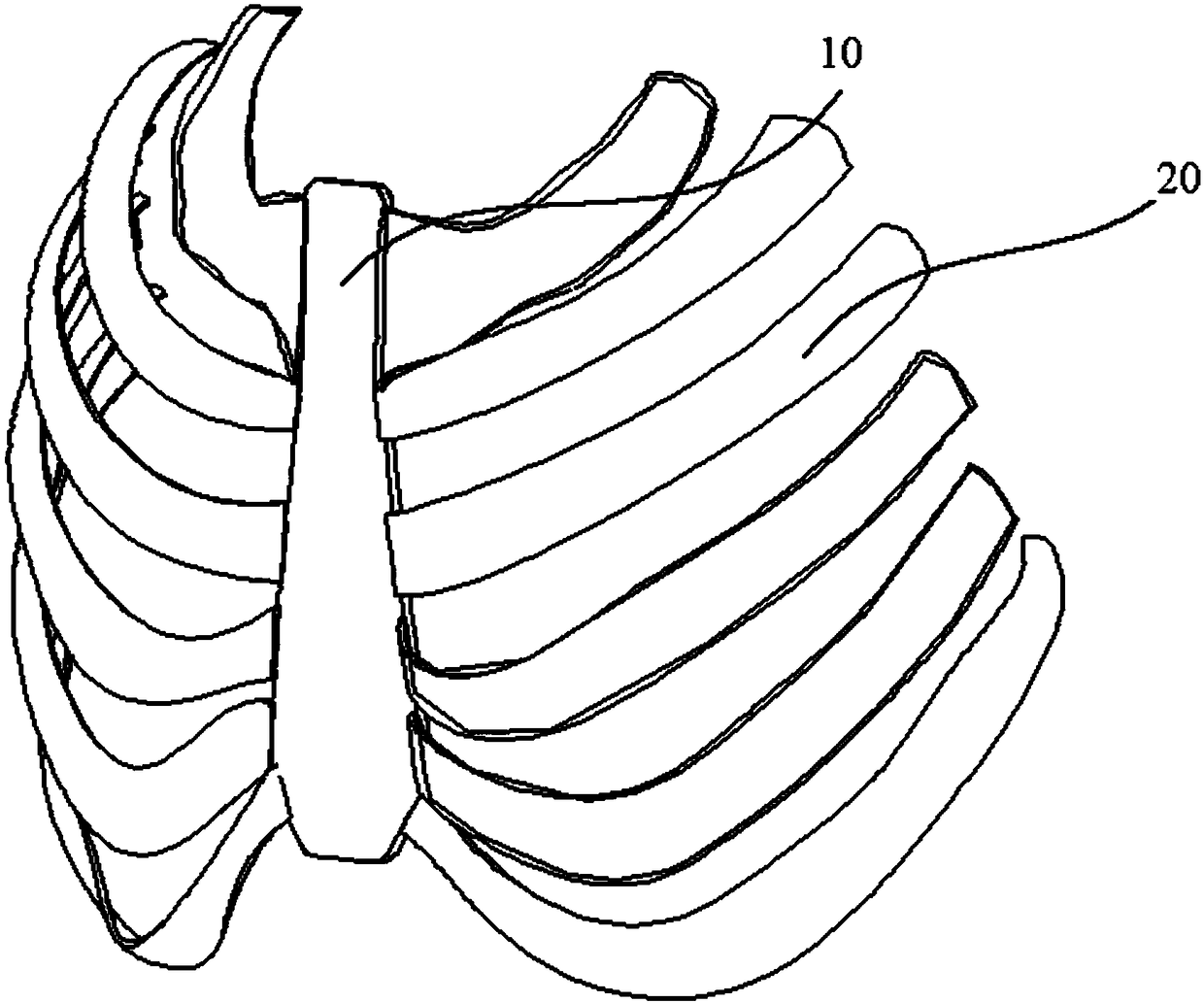 Sternal prosthesis device