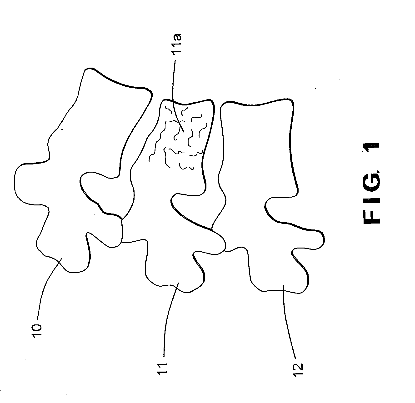 Posterior fixation device for percutaneous stabilization of thoracic and lumbar burst fractures