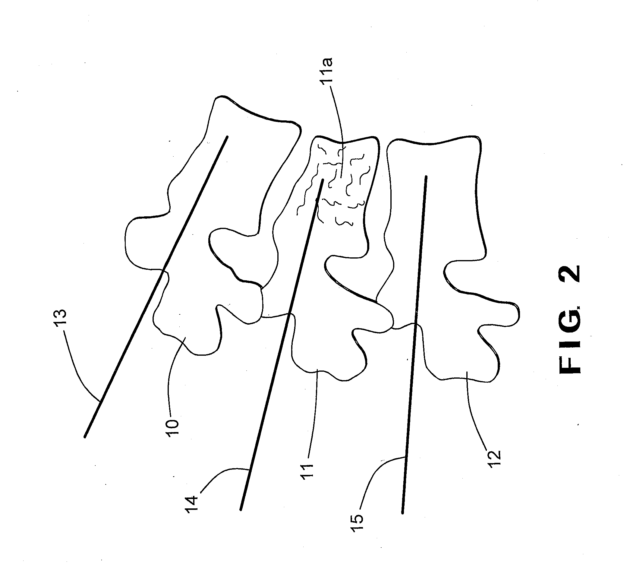 Posterior fixation device for percutaneous stabilization of thoracic and lumbar burst fractures