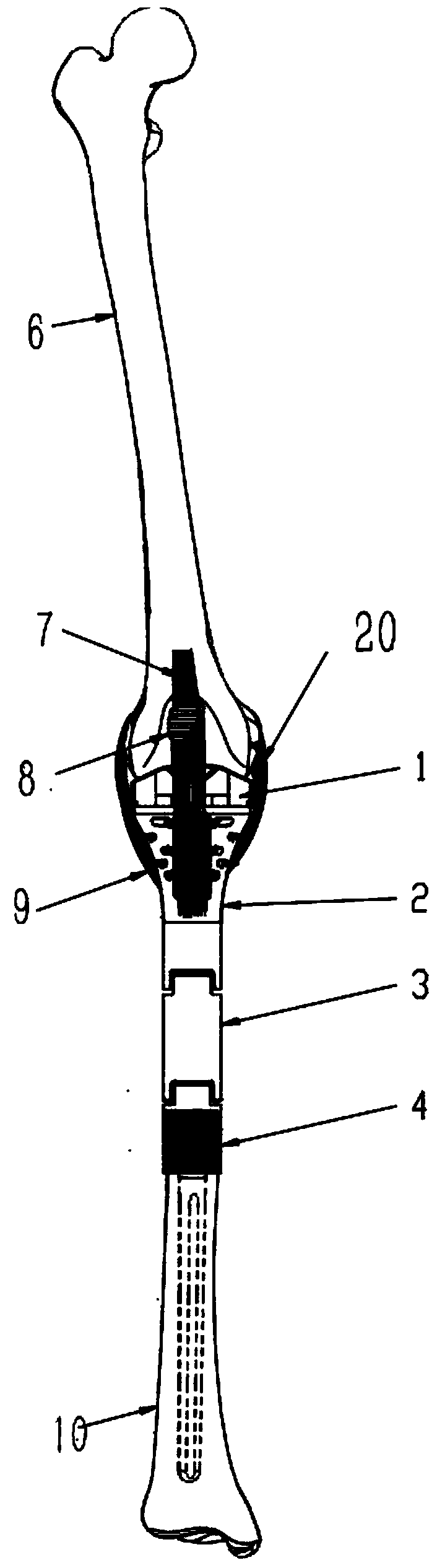 Ligament reserved assembled semi-knee-joint prosthesis for tibial tumor