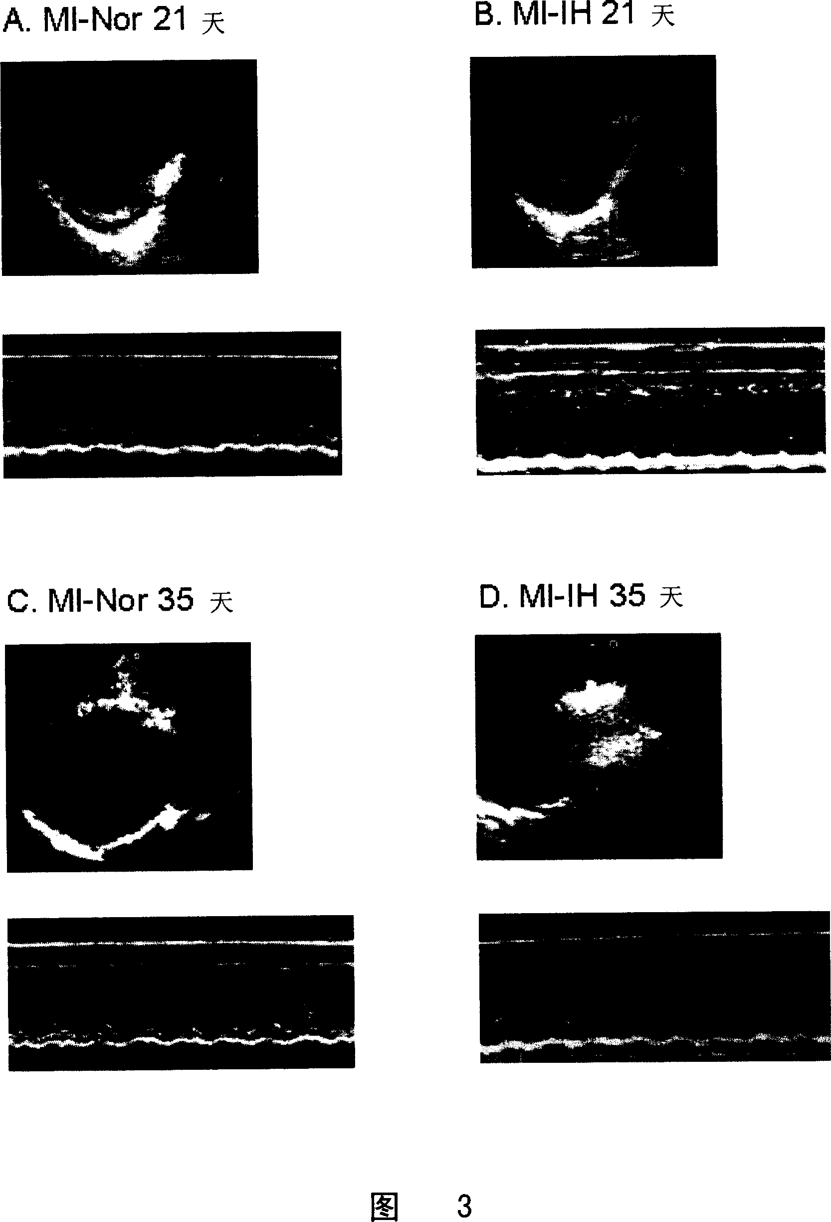 Therapeutic action of intermittent hypoxia for treating myocardiac infarction