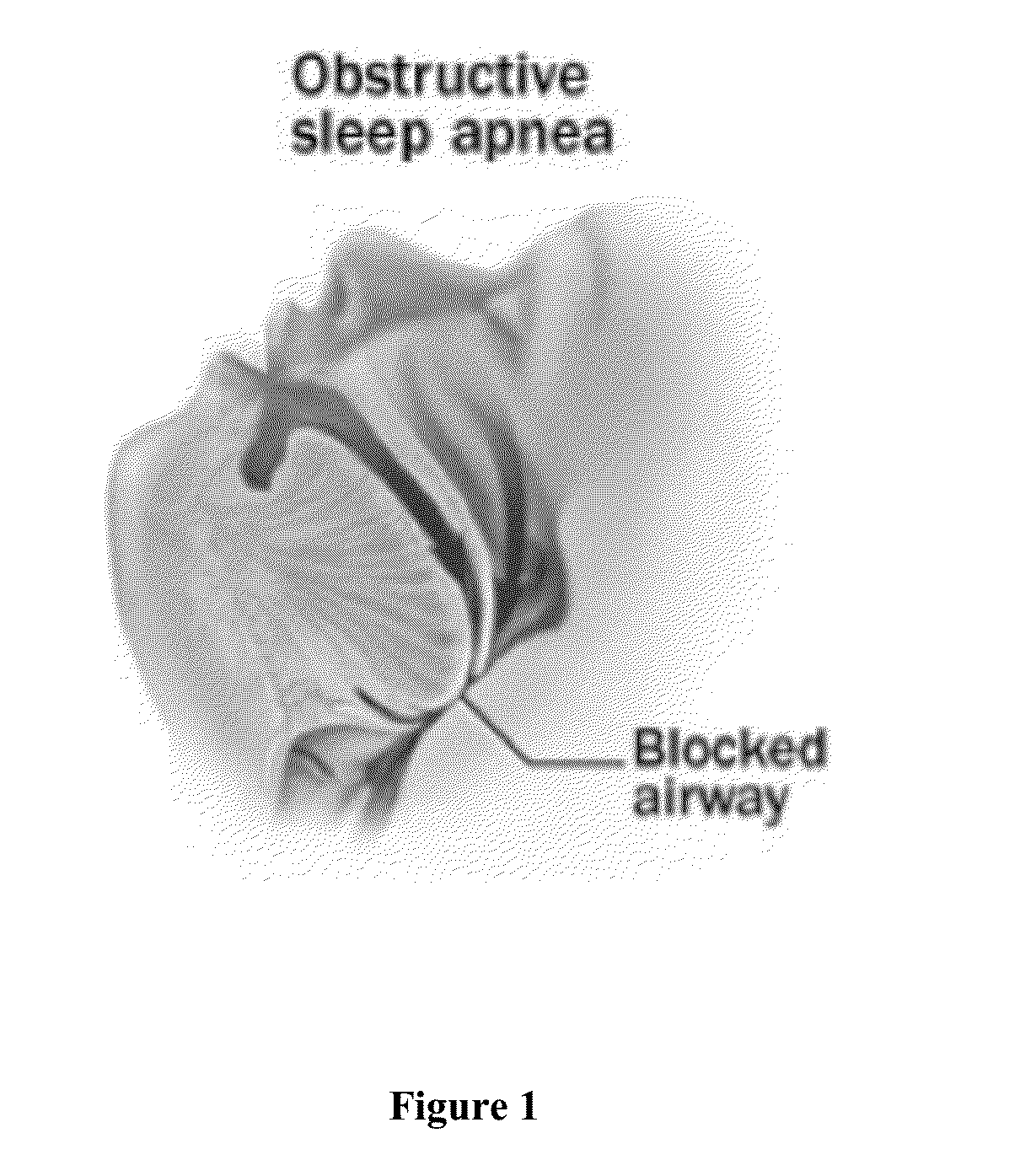 Obstructive Sleep Apnea Treatment Device