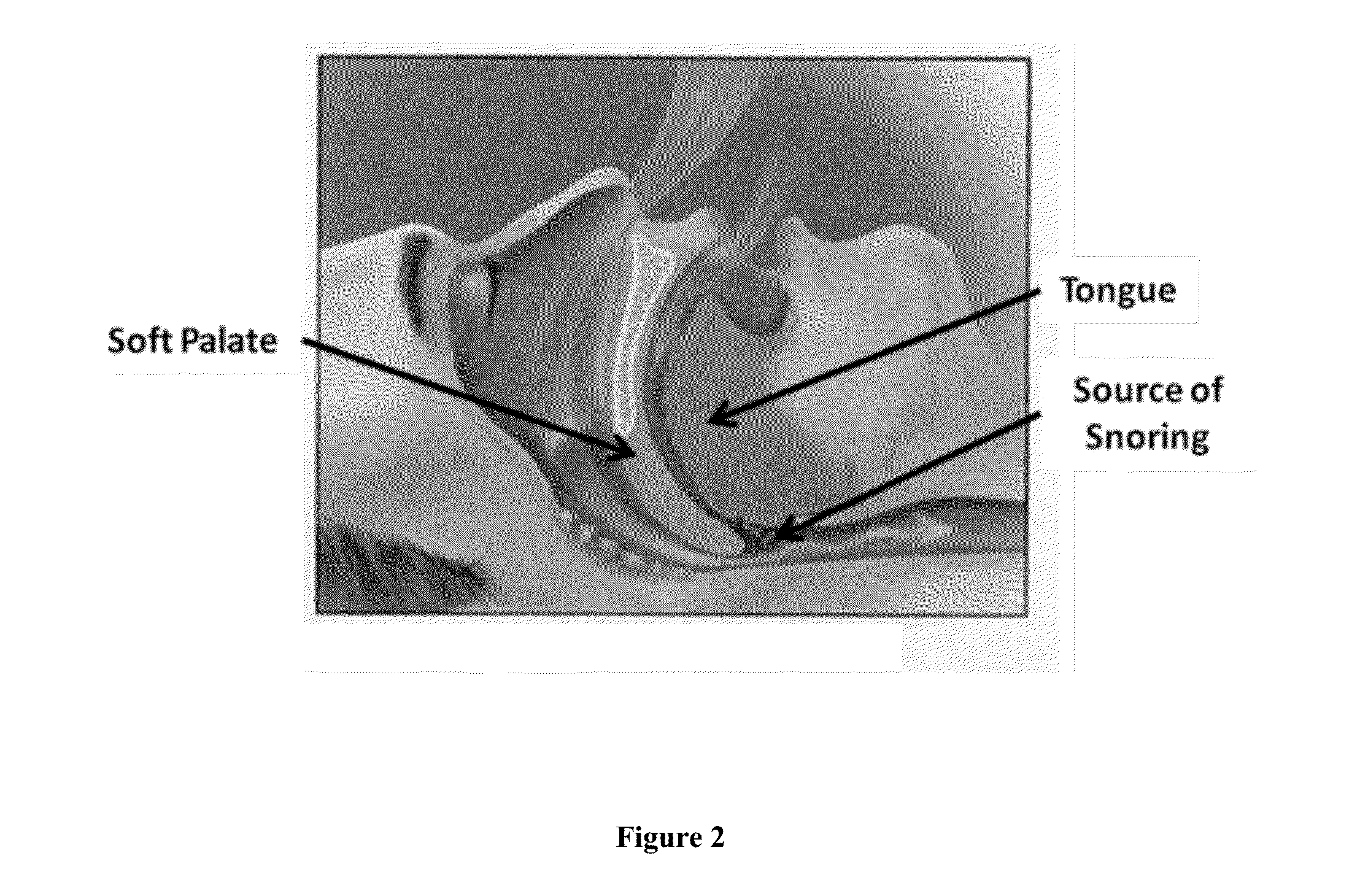 Obstructive Sleep Apnea Treatment Device