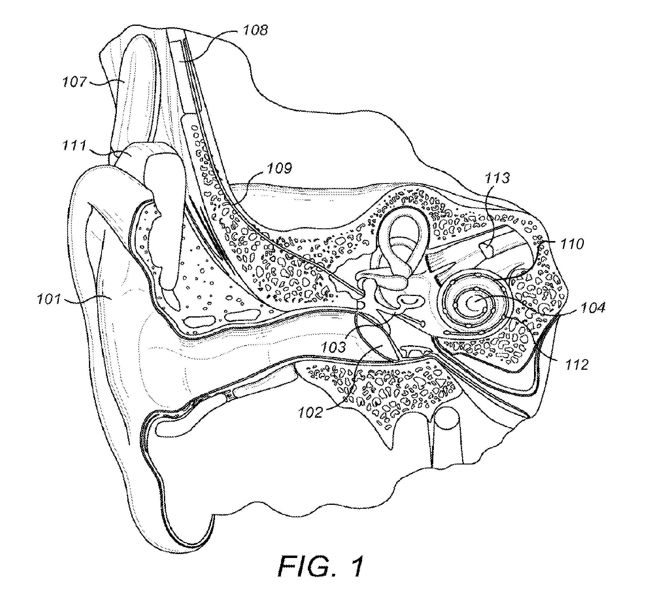 Objective allocation of implant electrode bands based on excitation spread