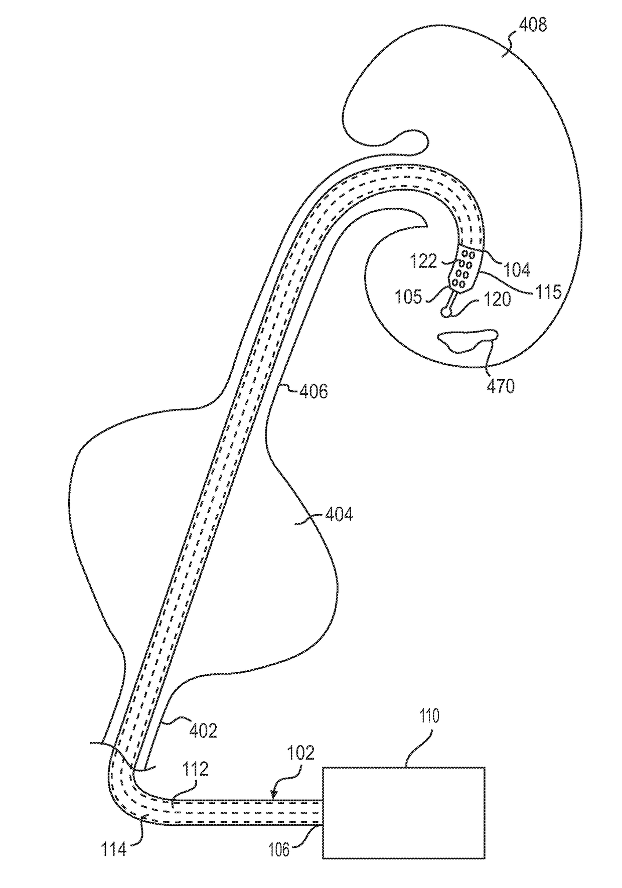 Medical device and methods of use