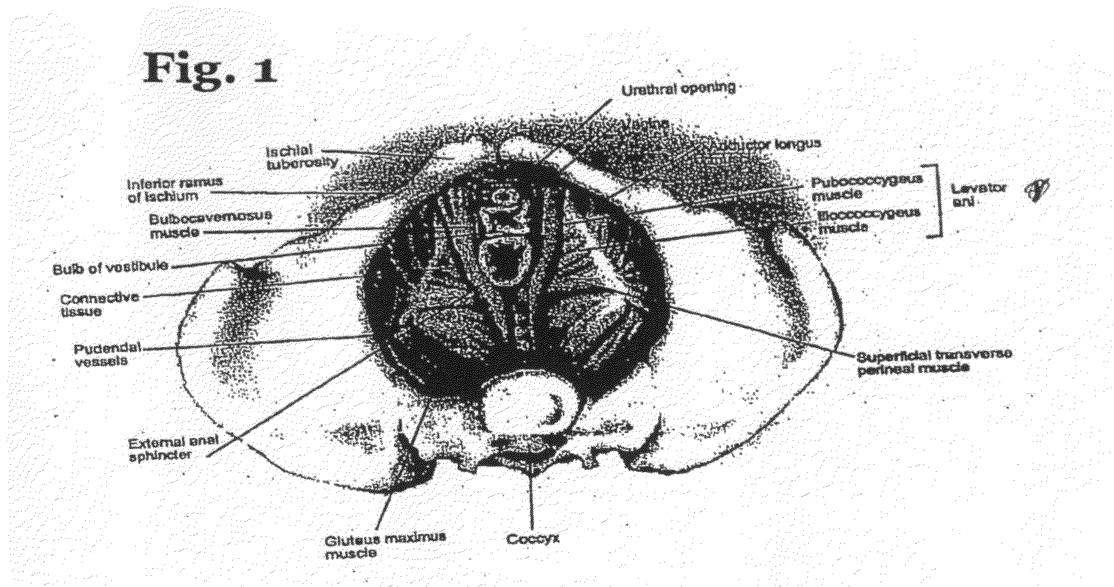 Levator for Repair of Perineal Prolapse