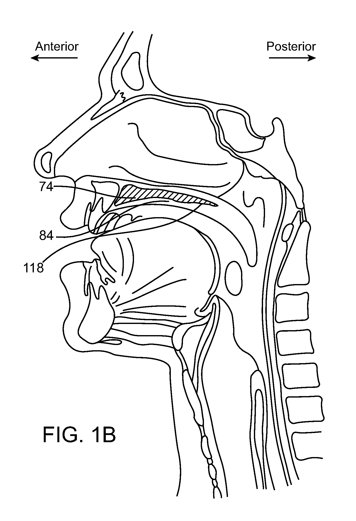 Delivery tools for sleep disorders treatment implant and methods of implantation