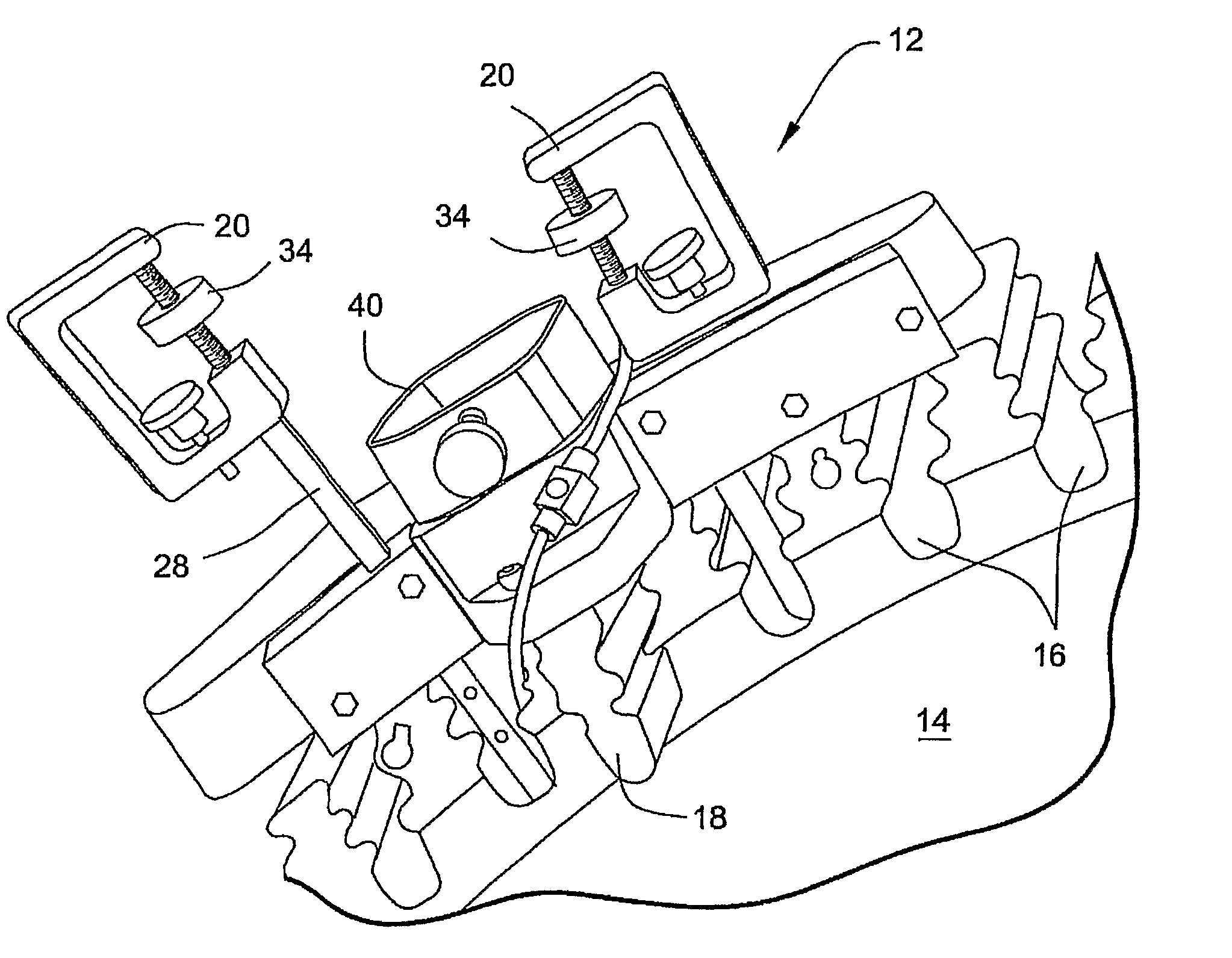 Ultrasonic peening treatment of assembled components