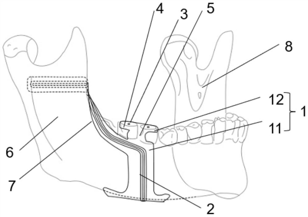 Lower jawbone osteotomy guide plate