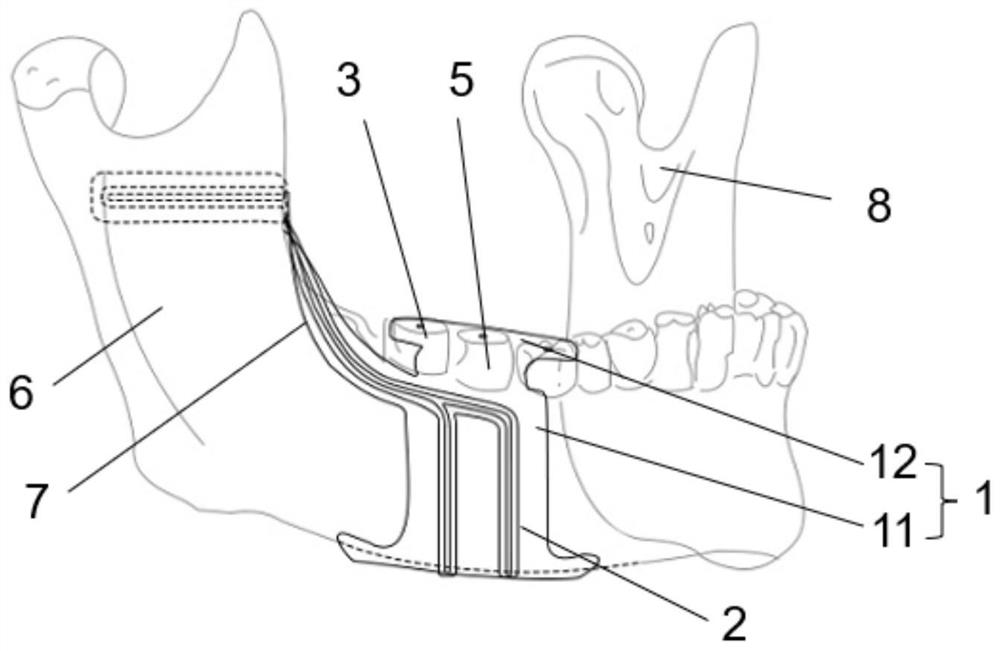 Lower jawbone osteotomy guide plate