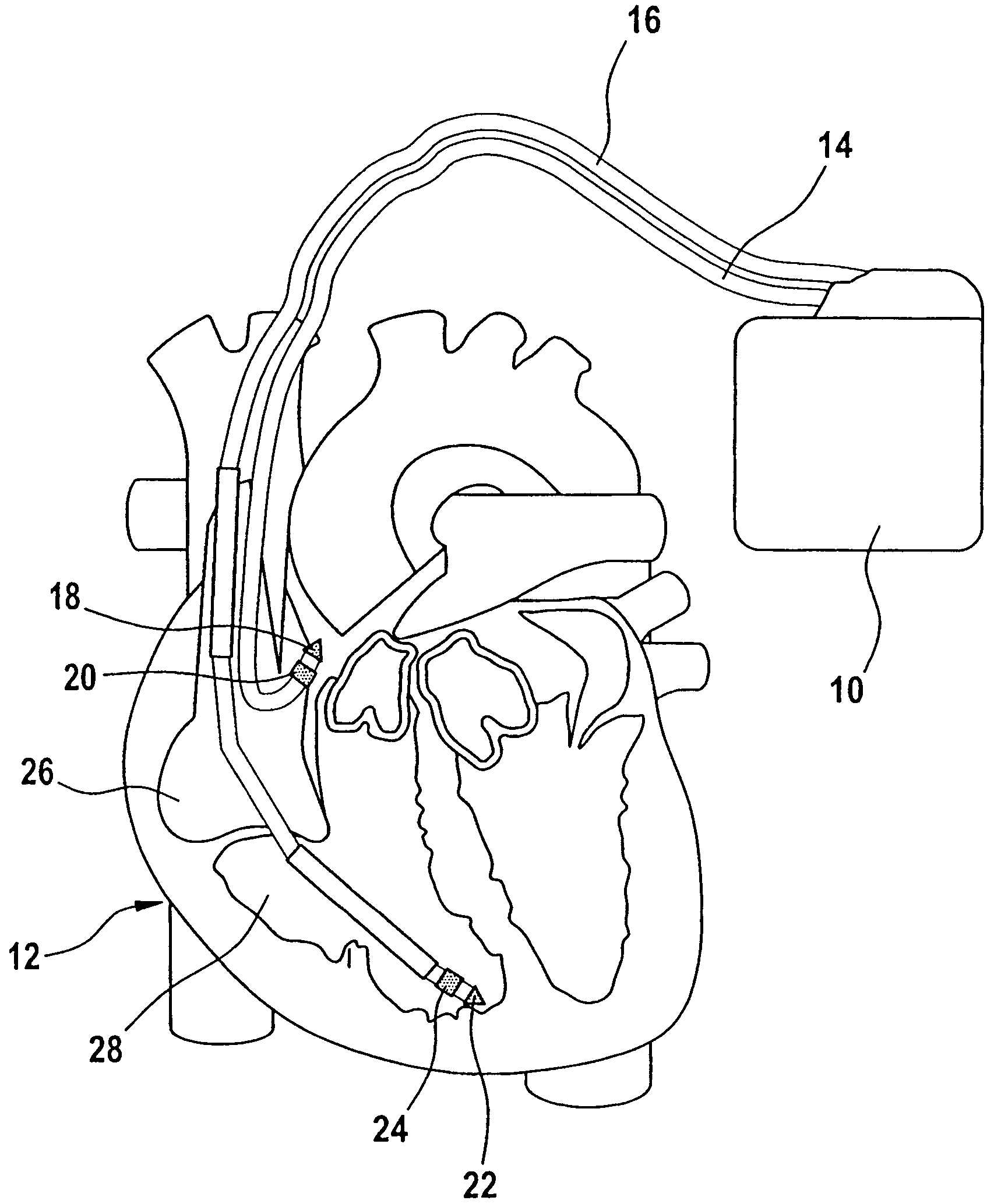 Heart stimulator using a Bezier function to define AV-delay values