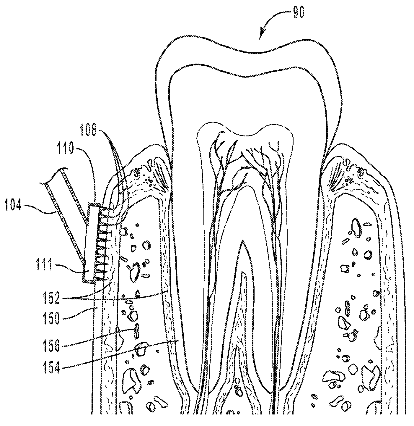 Method of dental tissue injection using an array of micro-needles