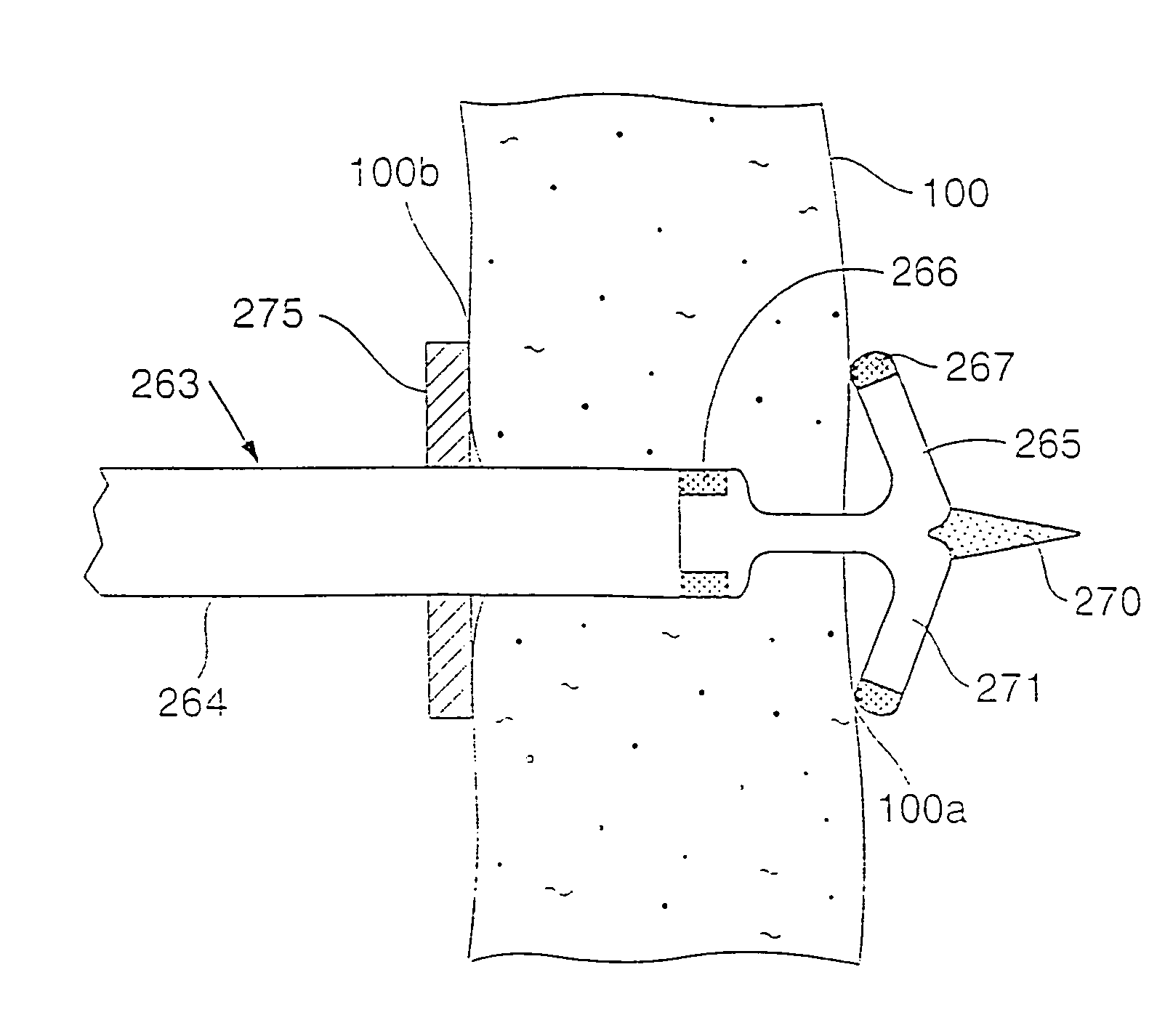 Gastric stimulation anchor and method